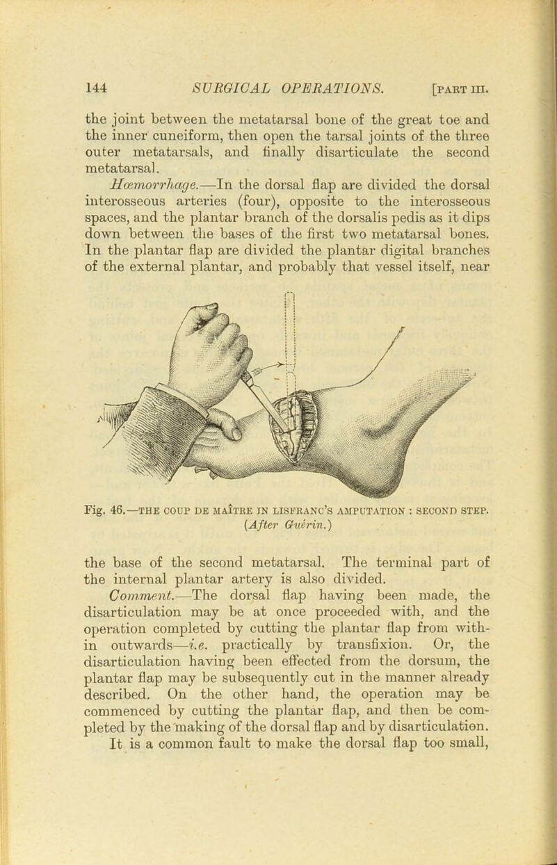 the joint between the metatarsal bone of the great toe and the inner cuneiform, then open the tarsal joints of the three outer metatarsals, and finally disarticulate the second metatarsal. llcemorrhage.—In the dorsal flap are divided the dorsal interosseous arteries (four), opposite to the interosseous spaces, and the plantar branch of the dorsalis pedis as it dips doAvn between the bases of the first two metatarsal bones. In the plantar flap are divided the plantar digital bi’anches of the external plantar, and probably that vessel itself, near Fig. 46.—THE COUP DE JIAITKE IN LISFRANC’S AMPUTATION : SECOND STEP. {After Guerin.) the base of the second metatarsal. The terminal part of the internal plantar artery is also divided. Comment.—The dorsal flap having been made, the disarticulation may be at once proceeded with, and the operation completed by cutting the plantar flap from with- in outwards—i.e. practically by transfixion. Or, the disarticulation having been effected from the dorsum, the plantar flap may be subsequently cut in the manner already described. On the other hand, the operation may be commenced by cutting the plantar flap, and then be com- pleted by the making of the dorsal flap and by disarticulation. It is a common fault to make the dorsal flap too small.