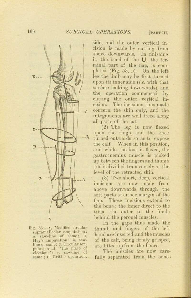 Fig. 53.—A, Modified circular supramalleolar amj)utation; a, saw-line of same; B, Key’s amputation: h, saw- line of same; c, Circular am- putation at “the place of election”; c, saw-line of same ; D, Gritti’s operation., side, and the outer vertical in- cision is made by cutting from above downwards. In finishing , O it, the bend of the U, the ter- minal part of the flap, is com- pleted (Fig. 53, b). On the left leg the limb may be first turned upon its inner side {i.e. with that surface looking downwards), and the operation commenced by cutting the outer vertical in- cision. The incisions thus made concern the skin only, and the integuments are well freed along all parts of the cut. (2) The leg is now flexed upon the thigh, and the knee turned outwards so as to expose the calf. When in this position, and while the foot is flexed, the gastrocnemius muscle is picked up between the fingers and thumb and is divided transversely at the level of the retracted skin. (3) Two short, deep, vertical incisions are now made from above downwards through the soft parts at either margin of the flap. These incisions extend to the bone: the inner direct to the tibia, the outer to the fibula behind the peronei muscles. In the gaps thus made the thumb and fingers of the left hand are inserted, and the muscles of the calf, being firmly grasped, are lifted up from the bones. The muscles are now care- fully separated from the bones