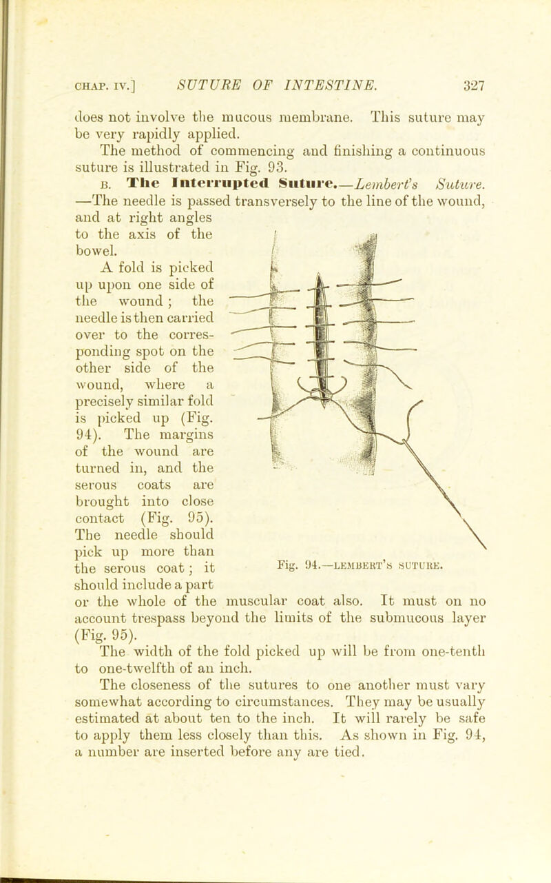 This suture may does not involve the mucous membrane, be very rapidly applied. The method of commencing and finishing a continuous suture is illustrated in Fig. 93. H. Tlie Interrupted Sntui-e.—Lemhert's Suture. —The needle is passed transversely to the line of the wound, and at right angles to the axis of the bowel. A fold is picked up upon one side of the wound ; the needle is then carried over to the corres- ponding spot on the other side of the wound, where a precisely similar fold is picked up (Fig. 94). The margins of the wound are turned in, and the serous brought Fii;. 94.—lemuert’s suture. coats are into close contact (Fig. 95). The needle should pick up more than the serous coat; it should include a part or the whole of the muscular coat also. It must on no account trespass beyond the limits of the submucous layer (Fig. 95). The width of the fold picked up will be from one-tenth to one-twelfth of an inch. The closeness of the sutures to one another must vary somewhat according to circumstances. They may be usually estimated at about ten to the inch. It will rarely be safe to apply them less closely than this. As shown in Fig. 94, a number are inserted before any are tied.