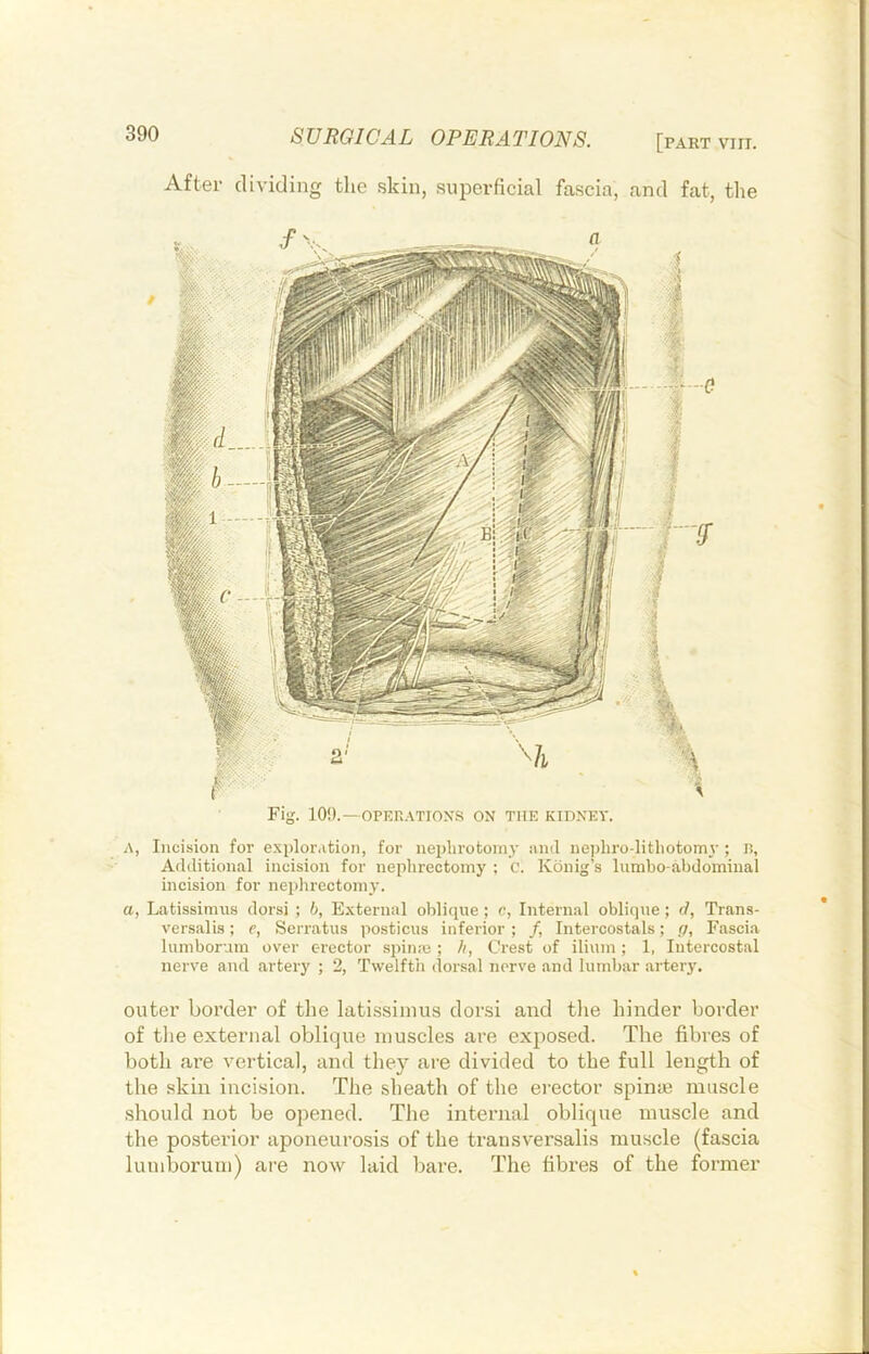 Fig. 10!).—OPER.VTIOXS ON THE KIDXEY. A, Incision for explor.ition, for neplirotoiny and nei)hro-litbotom\; B, Additional incision for nephrectomy ; C. Konig’s lnmbo-al)domiual incision for neplirectomy. a, Latissinnis dorsi ; b, External oblique; c, Internal oblique; d, Trans- versalis; e, Serratus posticus inferior ; /, Intercostals; p, Fascia lumborum over erector spina3; li, Crest of ilium; 1, Intercostal nerve and artery ; 2, Twelfth (lorsal nerve and lumbar artery. outer border of the latissiinus dor.si and the hinder border of tlie external oblique muscles are exposed. The fibres of both are vertical, and they are divided to the full length of the skin incision. The sheath of the ei-ector spinae muscle should not be opened. The internal oblique muscle and the posterior aponeurosis of the trausversalis muscle (fascia lumborum) are now laid bare. The fibres of the former 390 SURGICAL OPERATIONS. [part viri. After dividing the skin, superficial fascia, and fat, the