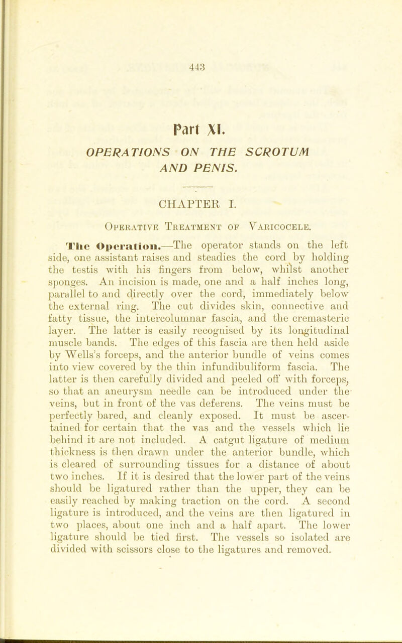 Part XI. OPERATIONS ON THE SCROTUM AND PENIS. CHAPTER I. Operative Treatment of Varicocele. Tlic Operation.—The operator stands on the left side, one assistant raises and steadies the cord by holding the testis with his fingers from below, whilst another sponges. An incision is made, one and a half inches long, parallel to and directly over the cord, immediately below the external ring. The cut divides skin, connective and fatty tissue, the intercolumnar fascia, and the cremasteric layer. The latter is easily recognised by its longitudinal muscle bands. The edges of this fascia are then held aside by Wells’s forceps, and the anterior bundle of veins comes into view covered by the thin infundibuliform fascia. The latter is then carefully divided and peeled off with forceps^ so that an aneurysm needle can be introduced under the veins, but in front of the vas deferens. The veins must be perfectly bared, and cleanly exposed. It must be ascer- tained for certain that the vas and the vessels which lie behind it are not included. A catgut ligature of medium thickness is then drawn under the anterior bundle, which is cleared of surrounding tissues for a distance of about two inches. If it is desired that the lower part of the veins should be ligatured rather than the upper, they can be easily reached by making traction on the cord. A second ligature is introduced, and the veins are then ligatured in two places, about one inch and a half apart. The lower ligature should be tied first. The vessels so isolated are divided with scissors close to the ligatures and removed.