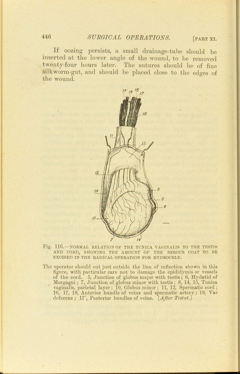 If oozing persists, a small drainage-tube should be inserted at the lower angle of the wound, to be removed twenty-four hours later. Tlie sutures should be of fine silkworm-gut, and should be placed close to the edges of the wound. Fig. 110.—NORMAL RELATION OF THE TUNICA VAGIN.VLIS TO THE TESTIS AND CORD, SHOWING THE AMOUNT OF THE SEROUS COAT TO BE EXCISED IN THE RADICAL OPERATION FOR HYDROCELE. The operator should cut just outside the line of reflection sliown in this figure, with particular care not to damage the epidid3'mis or vessels of the cord. 5, .Junction of globus major with testis; 6, Hydatid of lilorgagni; 7, Junction of globus minor with testis ; 8, 14, 15, Tunica vagin.alis, parietal layer; 10, Globus minor ; 11, 12, Spermatic cord ; IR, 17, 18, Anterior bundle of veins and spermatic artery; 19, Vas deferens ; 17', Posterior bundles of veins. {After Tcstut.)