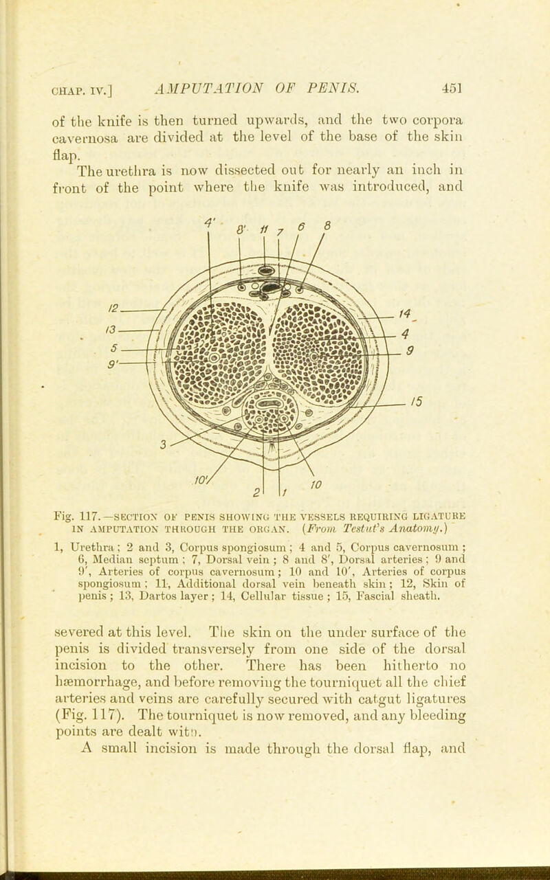 CHAP. IV.] of the knife is then turned upwards, and the two corpora cavernosa are divided at the level of the base of the skin flap. The urethra is now dissected out for nearly an inch in front of the point whei’e the knife was introduced, and Fig. 117.—SECTION' OF PENIS SHOWING THE VESSELS REQUIIUNG LIGATURE IN AMPUTATION THROUGH THE ORGAN. {From Tcstut's Anatomy.) 1, Urethra ; 2 and 3, Corpus spongiosum; 4 and 5, Corpus cavernosum ; 6, Median septum ; 7, Dorsal vein ; 8 and 8', Dorsal arteries; 9 and !)', Arteries of corpus cavernosum; 10 and 10', Arteries of corpus spongiosum ; 11, Additional dorsal vein beneath skin; 12, Skin of penis ; 13, Dartos layer; 14, Cellular tissue ; 15, Fascial sheath. severed at this level. Tlie skin on the under surface of the penis is divided transversely from one side of the dorsal incision to the other. There has been hitherto no luBinorrhage, and liefore removing the tourniquet all the chief arteries and veins are carefully secured with catgut ligatures (Fig. 117). The tourniquet is now removed, and any bleeding points are dealt with. A small incision is made through the dorsal flap, and