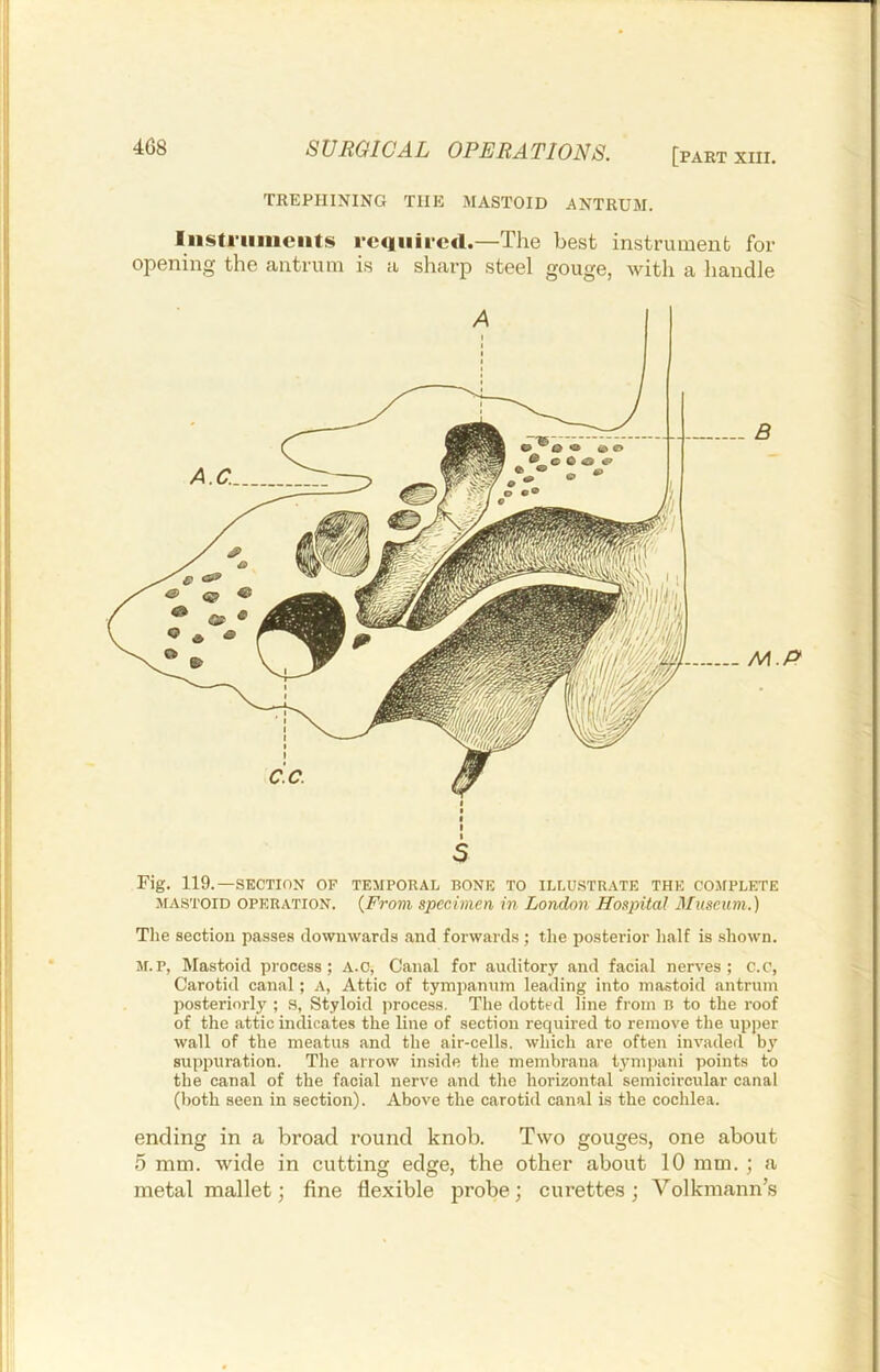 4G8 SUHGICAL OPERATIONS. [part xin. TREPHINING THE MASTOID ANTRUM. Iiisti'iiiiiciits required.—The best instrument for opening the antrum is a sharp steel gouge, with a handle - M.P Fig. 119.—SECTION OF TEMPORAL BONE TO ILLU.STRATE THE CO.MPLETE MASTOID OPERATION. {From specimen in London Hospital Museum.) Tlie section passes downwards and forwards ; the posterior lialf is shown. M.P, Mastoid process; A.O, Canal for auditory and facial nerves; c.c, Carotid canal; A, Attic of tympanum leading into mastoid antrum posteriorly ; S, Styloid process. The dotted line from n to the roof of the attic indicates the line of section required to remove the upper wall of the meatus and the air-cells, which are often invaded by suppuration. The arrow inside the membrana tymjiani points to the canal of the facial nerve and the horizontal semicircular canal (both seen in section). Above the carotid canal is the cochlea. ending in a broad round knob. Two gouges, one about 5 mm. wide in cutting edge, the other about 10 mm. ; a metal mallet; fine flexible probe; curettes ; Volkmann’s