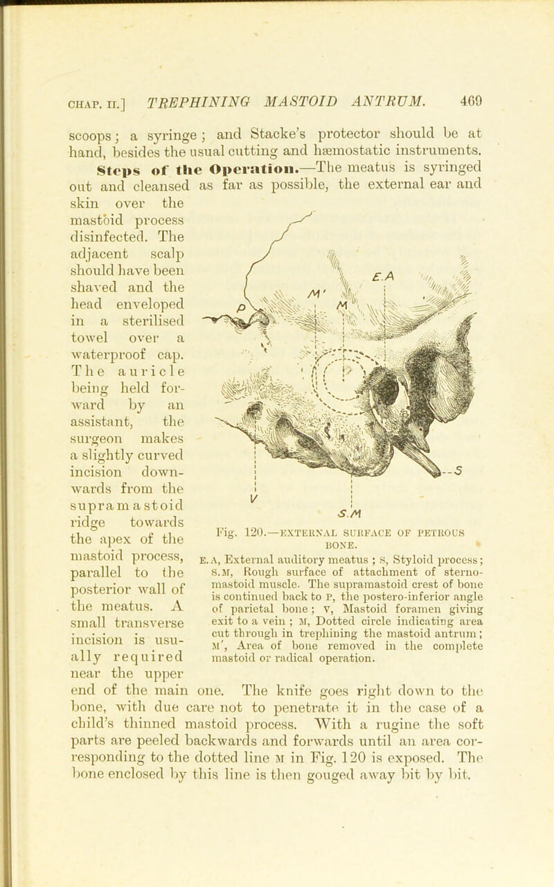 4C9 CHAP. II.] TREPHINING MASTOID ANTRUM. scoops; a syringe; and Stacke’s protector should be at hand, besides the usual cutting and hseinostatic instruments. Stops of flic Opcrsition.—Tlie meatus is syringed out and cleansed as far as possible, the external ear and skin over the mastoid process disinfected. The adjacent scalp should have been sha^•ed and the head enveloped in a sterilised towel over a waterproof cap. The auricle being held for- ward by an assistant, the surgeon makes a slightly curved incision down- wards from the supra m a stoid ridge towards the apex of the mastoid process, parallel to (he posterior wall of the meatus. A small transverse incision is usu- ally required near the upper end of the main one. The knife bone, Avith due care not to penetrate it in tlie case of a child’s thinned mastoid process. With a rugine the soft parts are peeled backwards and forwards until an area cor- responding to the dotted line m in Fig. 120 is exposed. The bone enclosed by this line is then gouged away bit by bit. Fig. 120.—KXTEUNAL SUHPACK OF PETKOL’S PONE. E.A, External auditory meatus ; s. Styloid procc.ss; s.sr. Rough surface of attachment of steruo- mastoid muscle. The supramastoid crest of bone is continued back to p, the postero-inferior .angle of parietal ))one; v, IMastoid foramen giving exit to a vein ; M, Dotted circle indicating area cut through in trephining the mastoid antrum ; m'. Area of bone removed in the complete mastoid or radical operation. goes right down to the