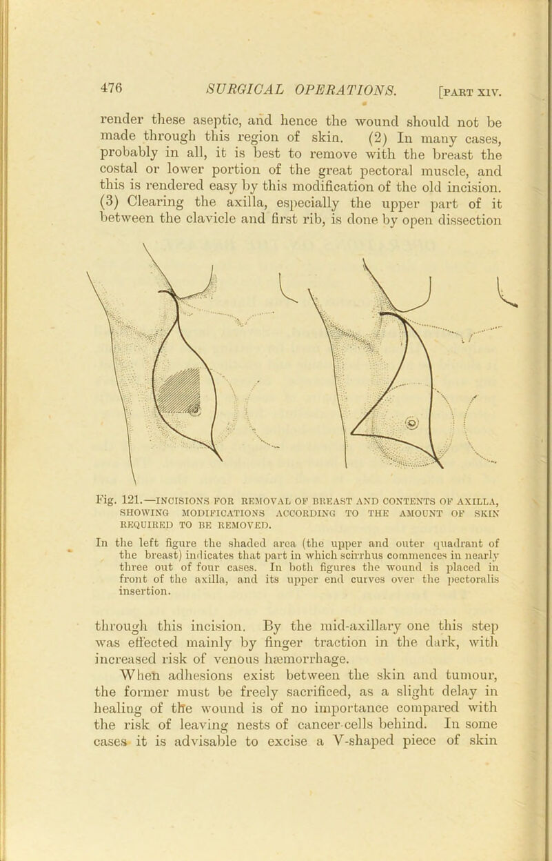 render these aseptic, and hence the wound .should not be made through this region of skin. (2) In many cases, probably in all, it is best to remove with the breast the costal or lower portion of the gi’eat pectoral muscle, and this is rendered easy by this modification of the old incision. (3) Clearing the axilla, especially the upper part of it between the clavicle and first rib, is done by open dissection Fig. 121.—INCISIONS FOR REMOVAL OF BREAST AND CONTENTS OF AXILLA, SHOWING MODIFICATIONS ACCORDING TO THE AMOUNT OF SKIN REQUIRED TO BE REMOVED. In the left figure the shaded area (tlie upper and outer quadrant of the breast) indicates that part in which scirrhus commences in nearly three out of four cases. In Ijoth figures the wound is placed in front of the axilla, and its upper end curves over the i)ectoralis insertion. through this incision. By the mid-axillary one this step was efi'ected mainly by finger traction in the dark, with increased risk of venous hiemorrhage. Wheti adhesions exist between the skin and tumour, the former must be freely sacrificed, as a slight delay in healing of the wound is of no importance compared with the risk of leaving nests of cancer-cel Is behind. In some case.i it is advisable to excise a V-shaped piece of skin