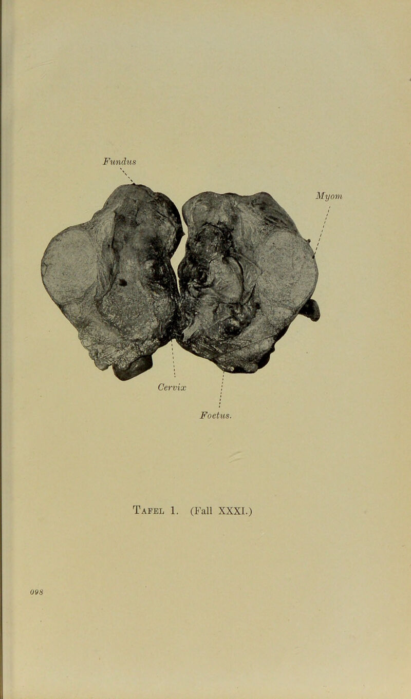 Cervix i Foetus. Tafel 1. (Fall XXXI.) 098