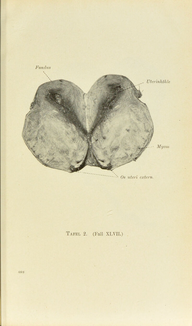 Uterinhöhle j Myom Os uteri extern.