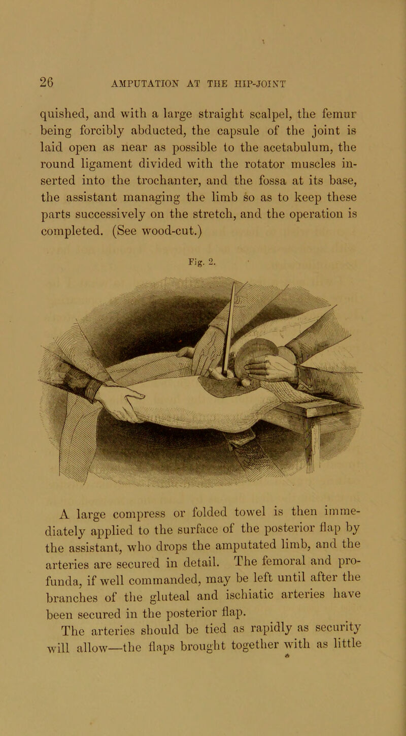 quished, and with a large straight scalpel, the femur being forcibly abducted, the capsule of the joint is laid open as near as possible to the acetabulum, the round ligament divided with the rotator muscles in- serted into the trochanter, and the fossa at its base, the assistant managing the limb so as to keep these parts successively on the stretch, and the operation is completed. (See wood-cut.) Fig. 2. A large compress or folded towel is then imme- diately applied to the surface of the posterior flap by the assistant, who drops the amputated limb, and the arteries are secured in detail. The femoral and pro- funda, if well commanded, may be left until after the branches of the gluteal and ischiatic aiteiies have been secured in the posterior flap. The arteries should be tied as rapidly as security will allow—the flaps brought together with as little A