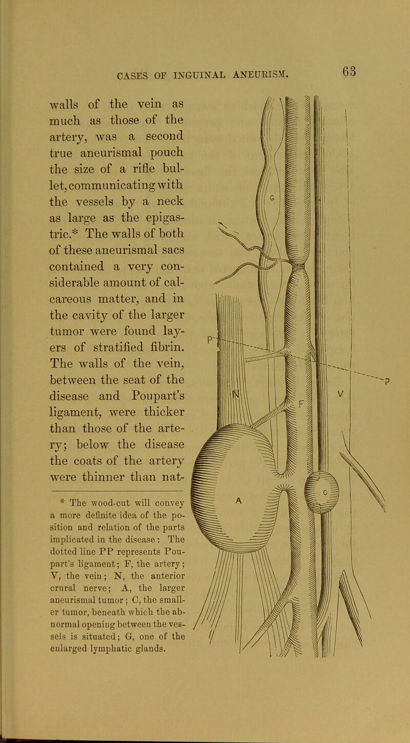 walls of the vein as much as those of the artery, was a second true aneurismal pouch the size of a rifle bul- let, communicating with the vessels by a neck as large as the epigas- tric.* The walls of both of these aneurismal sacs contained a very con- siderable amount of cal- careous matter, and in the cavity of the larger tumor were found lay- ers of stratified fibrin. The walls of the vein, between the seat of the disease and Poupart’s ligament, were thicker than those of the arte- ry; below the disease the coats of the artery were thinner than nat- * The wood-cut will convey a more definite idea of the po- sition and relation of the parts implicated in the disease: The dotted line PP represents Pou- part’s ligament; F, the artery; V, the vein; N, the anterior crural nerve; A, the larger aneurismal tumor; C, the small- er tumor, beneath which the ab- normal opening between the ves- sels is situated; G, one of the enlarged lymphatic glands. L