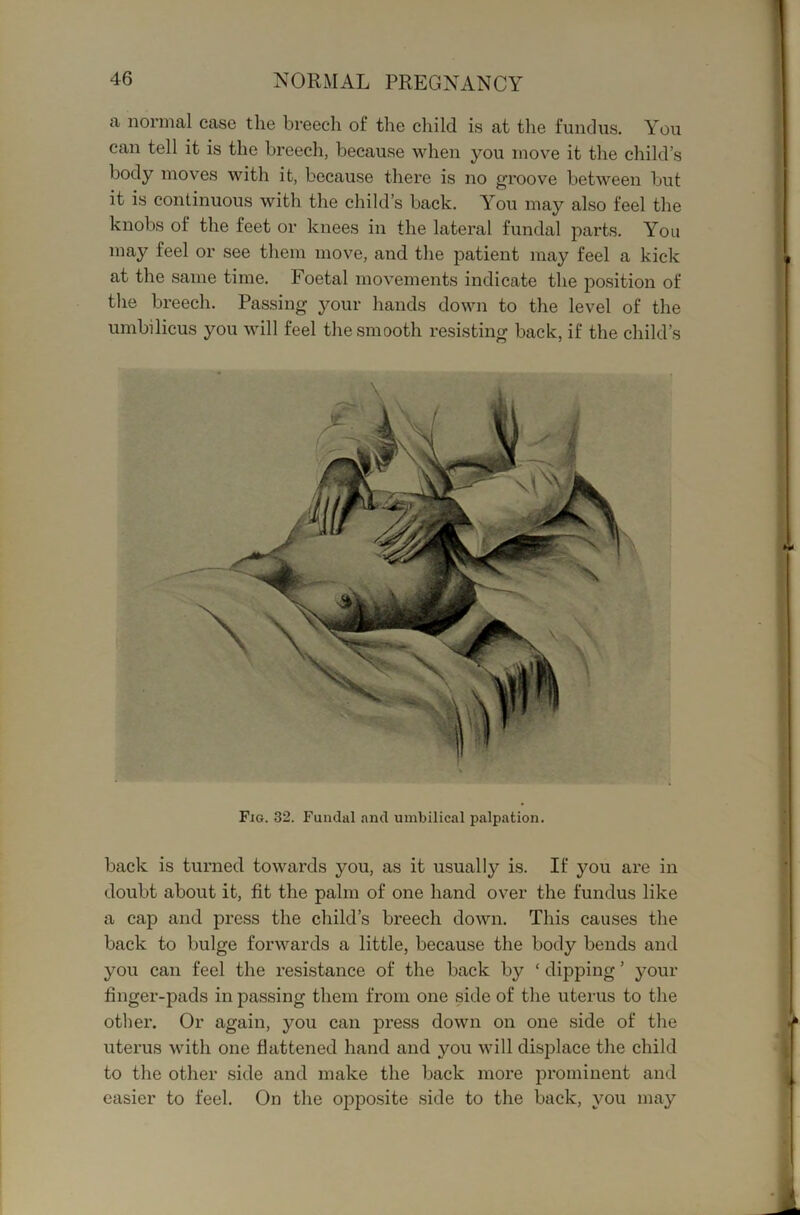 a normal case the breech of the child is at the fundus. You can tell it is the breech, because when you move it the child’s body moves with it, because there is no groove between but it is continuous with the child’s back. You may also feel the knobs of the feet or knees in the lateral fundal joarts. You may feel or see them move, and the patient may feel a kick at the same time. Foetal movements indicate the position of the breech. Passing your hands down to the level of the umbilicus you will feel the smooth resisting back, if the child’s Fig. 32. Fuiulal and umbilical palpation. back is turned towards you, as it usually is. If you are in doubt about it, fit the palm of one hand over the fundus like a cap and press the child’s breech down. This causes the back to bulge forwards a little, because the body bends and you can feel the resistance of the back by ‘ dipping ’ your finger-pads in passing them from one side of the uterus to the other. Or again, you can press down on one side of the uterus with one flattened hand and you will displace the child to the other side and make the back more prominent and easier to feel. On the opposite side to the back, you may