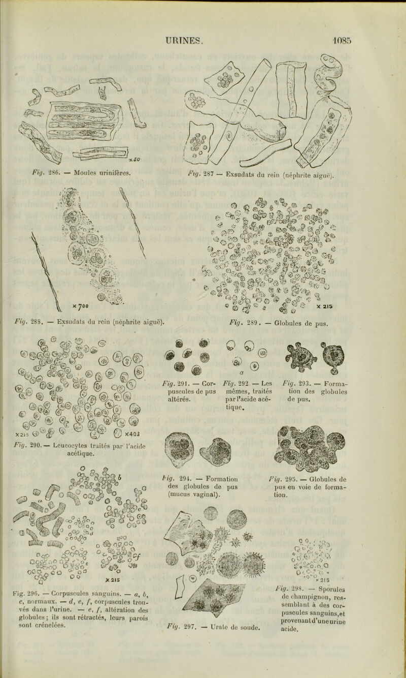 Fig. 286. — Moules urinifères. Fkj, 287 — Exsudais du rein (néplirite aigur). ^ Fig. 288. — Exsudais du rein (néphrite aiguë). O - 'Çf5'. Mim X403 Fig. 290.— Leucocytes traités par l’acide acétique. Gq.' ,^9 Q o‘io d jOOfpO ü O O ?cA>^ O O a^O O ^ GC PO X2IS Fig. 290. — Corpuscules sanguins. — «, /;, c, normaux. — d, e, f, corpuscules trou- vés dans l’urine. — e, /', altération dos globules ; ils sont rétracté-s, leurs parois sont crénelées. Fig. 289 . — Globules de pus. Fig. 291. — Cor- Fig. 292 — Les puscules de pus mêmes, traités altérés. par l’acide acé- tique. Fig. 293. — Forma- tion des globules de pus. hig. 294. — Formation des globules de pus (mucus vaginal). Fig. 295. — Globules do pus en voie de forma- tion. Fig. 297. — Urato de soude. ô^^'.^Sc^b.o Q O. C; ” vT .. (-■ - f.', W •0Ü X 215 Fig. 298. — Sporulos do champignon, ro.s- semblant à des cor- puscules sanguins,et provenantd’une urine acide.