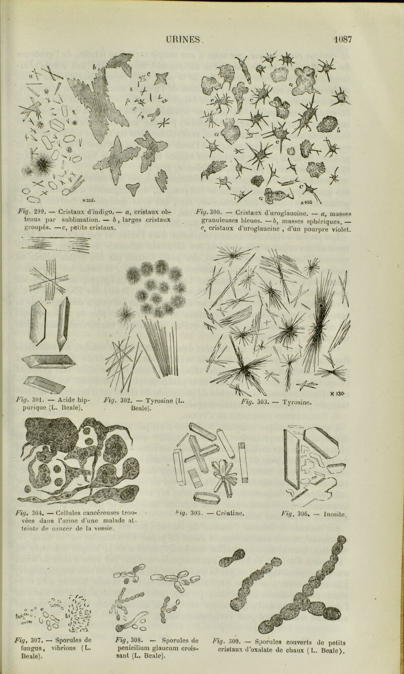 Fig. 299. — Cristaux d’indigo. — a, cristaux ob- tenus par sublimation. — h , larges cristaux groupés. —c, petits cristaux. granuleuses bleues. —ù, masses s[)hériques. — c, cristaux d’uroglaucine , d’un pourpre violet. Fig. 301. — Acide hip- purique (L. Beale). Fig. 302. — Tyrosine (L. Fig. 303. — Tyrosine. Beale). Fig. 304. — Cellules cancéreuses trou- vées dans Tu ri ne d’une malade at- teinte de cancer de la vessie. Fig, 306. — Jnosite. O . r 'O r O U O ^ 7* I o.ao (j Q-;^ Fig, 307. — Sporules de fungus, vibrions (L. Beale). Fig, 308. — Sporules de penicilium glaucum crois- sant (L. Beale). Fig. 309. — Sporules couverts de petits cristaux d’oxalate do chaux ( L. Beale),