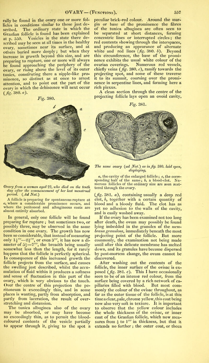 rally be found in the ovary one or more fol- licles in conditions similar to those just de- scribed. The ordinary state in which the Graafian follicle is found has been explained at p. 550. Vesicles in the state there de- scribed may be seen at all times in the healthy ovary, sometimes near its surface, and at others buried more deeply; but. when they increase in growth beyond this size, and are preparing to rupture, one or more will always be found approaching the periphery of the ovary, or rising above the level of its outer tunics, constituting there a nipple-like pro- minence, so distinct as at once to arrest attention, and to point out the part of the ovary in which the dehiscence will next occur (fig. 380. a). Fig. 380. Ovary from a woman aged 22, who died on the tenth day after the commencement of her last menstrual period. {Ad Nat.') A follicle is preparing for spontaneous rupture at a, where a considerable prominence occurs, and where the peritoneal and albugineous coats are almost entirely absorbed. In general, only one follicle will be found preparing for rupture ; but sometimes two, or possibly three, may be observed in the same condition in one ovary. The growth has now been so considerable, that instead of measuring only —2i///, or even 3W, it has now a di- ameter of 5\—7///, the breadth being usually somewhat less than the length, for it rarely happens that the follicle is perfectly spherical. In consequence of this increased growth the follicle projects from the surface, and causes the swelling just described, whilst the accu- mulation of fluid within it produces a softness and sense of fluctuation in this part of the ovary, which is very obvious to the touch. Over the centre of this projection the pe- ritoneum is exceedingly thin, and in some places is wanting, partly from absorption, and partly from laceration, the result of over- stretching and distension. The tunica albuginea also of the ovary may be absorbed, or may have become so exceedingly thin, as to permit the blood- coloured contents of the vesicle partially to appear through it, giving to the spot a peculiar brick-red colour. Around the mar- gin or base of the prominence the fibres of the tunica albuginea are often seen to be separated at short distances, forming concentric lines or interrupted circles; the red contents showing through the interspaces, and producing an appearance of alternate white and red lines (fig. 380. h). Beyond this circumference, the base of the promi- nence exhibits the usual white colour of the ovarian coverings. Numerous red vessels, chiefly veins {fig. 380. c), ramify towards the projecting spot, and some of these traverse it to its summit, coursing over the promi- nence in serpentine lines, and forming here a rich plexus. A clean section through the centre of the projecting follicle lays open an ovoid cavity, Fig. 381. The same ovary (ad Nat,.') as in fig. 380. laid open, displaying, a, the cavity of the enlarged follicle; c, the corre- sponding half of the same; b, a blood-clot. Nu- merous follicles of the ordinary size are seen scat- tered through the ovary. (fig. 381. a), containing usually a deep red clot, h, together with a certain quantity of blood and a bloody fluid. The clot has as yet no adhesion to the walls of the cavity, and is easily washed away. If the ovary has been examined not too long after death, the ovum may possibly be found lying imbedded in the granules of the mem- hrana granulosa, immediately beneath the most projecting point of the follicle. But more commonly, the examination not being made until after this delicate membrane has melted down, and its granules have become dispersed by post-mortem change, the ovum cannot be discovered. After washing out the contents of the follicle, the inner surface of the ovisac is ex- posed (fig. 381. c). This I have occasionally seen to be of an intense red colour, from the surface being covered by a rich network of ca- pillaries filled with blood. But most com- monly the colour of the ovisac throughout, as far as the outer tissue of the follicle, is at this time a clear, pale, chrome yellow, this coat being now also very soft in texture. It is important to observe that the yellow colour includes the whole thickness of the ovisac, or inner coat of the Graafian follicle, which now mea- sures from -J- to V in thickness, but that it extends no further; the outer coat, or theca