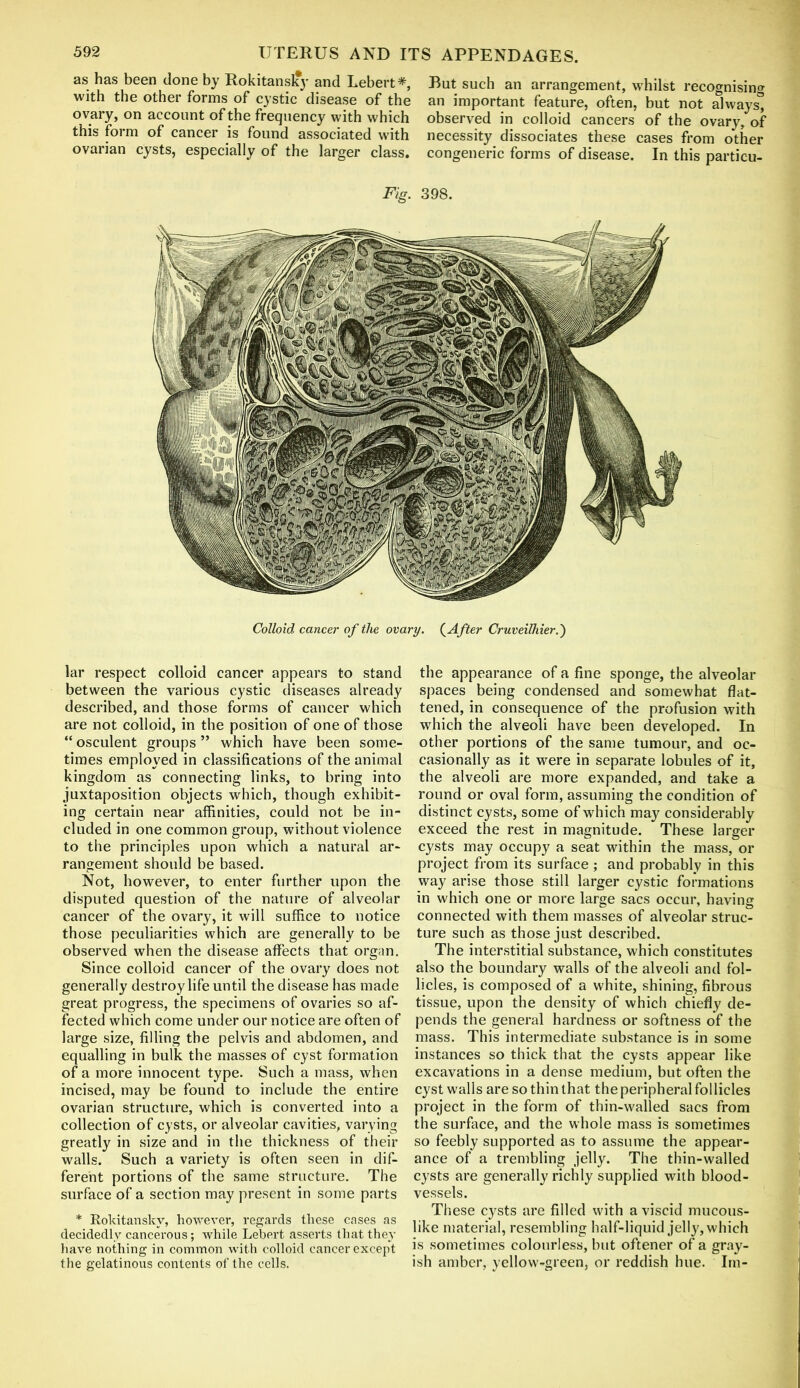 as has been done by Rokitansky and Lebert*, But such an arrangement, whilst recognising with the other forms of cystic disease of the an important feature, often, but not always° ovary, on account of the frequency with which observed in colloid cancers of the ovary, of this form of cancer is found associated with necessity dissociates these cases from other ovarian cysts, especially of the larger class, congeneric forms of disease. In this particu- Fig. 398. Colloid cancer of the ovary. (After Cruveilhier.') lar respect colloid cancer appears to stand between the various cystic diseases already described, and those forms of cancer which are not colloid, in the position of one of those “ osculent groups ” which have been some- times employed in classifications of the animal kingdom as connecting links, to bring into juxtaposition objects which, though exhibit- ing certain near affinities, could not be in- cluded in one common group, without violence to the principles upon which a natural ar- rangement should be based. Not, however, to enter further upon the disputed question of the nature of alveolar cancer of the ovary, it will suffice to notice those peculiarities which are generally to be observed when the disease affects that organ. Since colloid cancer of the ovary does not generally destroy life until the disease has made great progress, the specimens of ovaries so af- fected which come under our notice are often of large size, filling the pelvis and abdomen, and equalling in bulk the masses of cyst formation of a more innocent type. Such a mass, when incised, may be found to include the entire ovarian structure, which is converted into a collection of cysts, or alveolar cavities, varying greatly in size and in the thickness of their walls. Such a variety is often seen in dif- ferent portions of the same structure. The surface of a section may present in some parts * Rokitansky, however, regards these cases as decidedly cancerous; while Lebert. asserts that they have nothing in common with colloid cancer except the gelatinous contents of the cells. the appearance of a fine sponge, the alveolar spaces being condensed and somewhat flat- tened, in consequence of the profusion with which the alveoli have been developed. In other portions of the same tumour, and oc- casionally as it were in separate lobules of it, the alveoli are more expanded, and take a round or oval form, assuming the condition of distinct cysts, some of which may considerably exceed the rest in magnitude. These larger cysts may occupy a seat within the mass, or project from its surface ; and probably in this way arise those still larger cystic formations in which one or more large sacs occur, having connected with them masses of alveolar struc- ture such as those just described. The interstitial substance, which constitutes also the boundary walls of the alveoli and fol- licles, is composed of a white, shining, fibrous tissue, upon the density of which chiefly de- pends the general hardness or softness of the mass. This intermediate substance is in some instances so thick that the cysts appear like excavations in a dense medium, but often the cyst walls are so thin that the peripheral fol licles project in the form of thin-walled sacs from the surface, and the whole mass is sometimes so feebly supported as to assume the appear- ance of a trembling jelly. The thin-walled cysts are generally richly supplied with blood- vessels. These cysts are filled with a viscid mucous- like material, resembling half-liquid jelly, which is sometimes colourless, but oftener of a gray- ish amber, yellow-green, or reddish hue. Im-