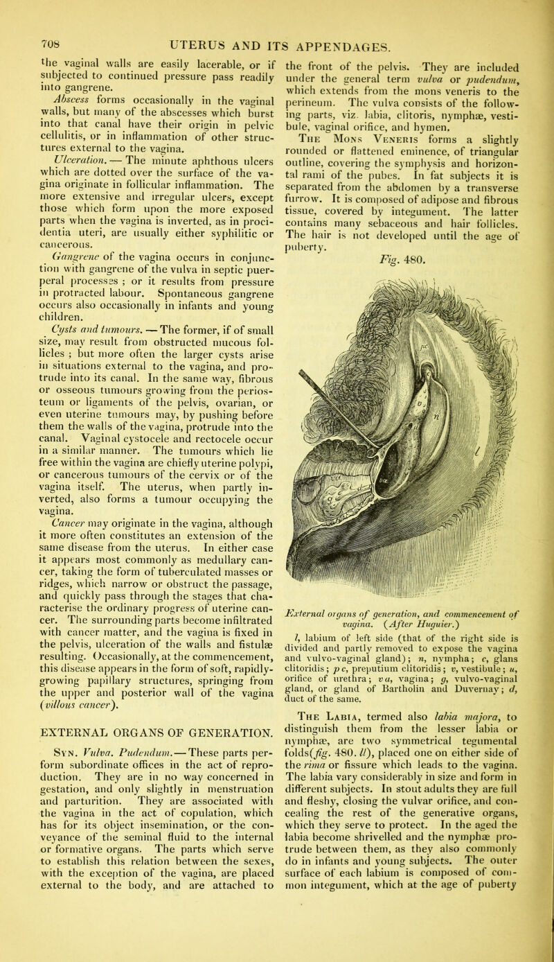 the vaginal walls are easily lacerable, or if subjected to continued pressure pass readily into gangrene. Abscess forms occasionally in the vaginal walls, but many of the abscesses which burst into that canal have their origin in pelvic cellulitis, or in inflammation of other struc- tures external to the vagina. Ulceration.— The minute aphthous ulcers which are dotted over the surface of the va- gina originate in follicular inflammation. The more extensive and irregular ulcers, except those which form upon the more exposed parts when the vagina is inverted, as in proci- dentia uteri, are usually either syphilitic or cancerous. Gangrene of the vagina occurs in conjunc- tion with gangrene of the vulva in septic puer- peral processes ; or it results from pressure in protracted labour. Spontaneous gangrene occurs also occasionally in infants and young children. Cysts and tumours. — The former, if of small size, may result from obstructed mucous fol- licles ; but more often the larger cysts arise in situations external to the vagina, and pro- trude into its canal. In the same way, fibrous or osseous tumours growing from the perios- teum or ligaments of the pelvis, ovarian, or even uterine tumours may, by pushing before them the walls of the vagina, protrude into the canal. Vaginal cystocele and rectocele occur in a similar manner. The tumours which lie free within the vagina are chiefly uterine polypi, or cancerous tumours of the cervix or of the vagina itself. The uterus, when partly in- verted, also forms a tumour occupying the vagina. Cancer may originate in the vagina, although it more often constitutes an extension of the same disease from the uterus. In either case it appears most commonly as medullary can- cer, taking the form of tuberculated masses or ridges, which narrow or obstruct the passage, and quickly pass through the stages that cha- racterise the ordinary progress of uterine can- cer. The surrounding parts become infiltrated with cancer matter, and the vagina is fixed in the pelvis, ulceration of the walls and fistulae resulting. Occasionally, at the commencement, this disease appears in the form of soft, rapidly- growing papillary structures, springing from the upper and posterior wall of the vagina (villous cancer). EXTERNAL ORGANS OF GENERATION. Syn. Vulva. Pudendum. — These parts per- form subordinate offices in the act of repro- duction. They are in no way concerned in gestation, and only slightly in menstruation and parturition. They are associated with the vagina in the act of copulation, which has for its object insemination, or the con- veyance of the seminal fluid to the internal or formative organs. The parts which serve to establish this relation between the sexes, with the exception of the vagina, are placed external to the body, and are attached to the front of the pelvis. They are included under the general term vulva or pudendum, which extends from the mons veneris to the perineum. The vulva consists of the follow- ing parts, viz. labia, clitoris, nymphae, vesti- bule, vaginal orifice, and hymen. The Mons Veneris forms a slightly rounded or flattened eminence, of triangular outline, covering the symphysis and horizon- tal rami of the pubes. In fat subjects it is separated from the abdomen by a transverse furrow. It is composed of adipose and fibrous tissue, covered by integument. The latter contains many sebaceous and hair follicles. The hair is not developed until the age of puberty. Fig. 480. External organs of generation, and commencement of vagina. (After Huguier.') I, labium of left side (that of the right side is divided and partly removed to expose the vagina and vulvo-vaginal gland); n, nympha; c, glans clitoridis ; p c, preputium clitoridis ; v, vestibule; u, orifice of urethra; va, vagina; g, vulvo-vaginal gland, or gland of Bartholin and Duvernay; d, duct of the same. The Labia, termed also labia majora, to distinguish them from the lesser labia or nymphae, are two symmetrical tegumental folds(j%. 480. //), placed one on either side of the rima or fissure which leads to the vagina. The labia vary considerably in size and form in different subjects. In stout adults they are full and fleshy, closing the vulvar orifice, and con- cealing the rest of the generative organs, which they serve to protect. In the aged the labia become shrivelled and the nymphae pro- trude between them, as they also commonly do in infants and young subjects. The outer surface of each labium is composed of com- mon integument, which at the age of puberty