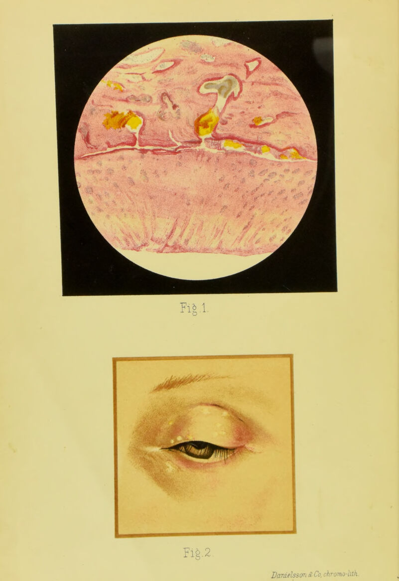 Fig. 2 Danielsson & Co, chromo-hth