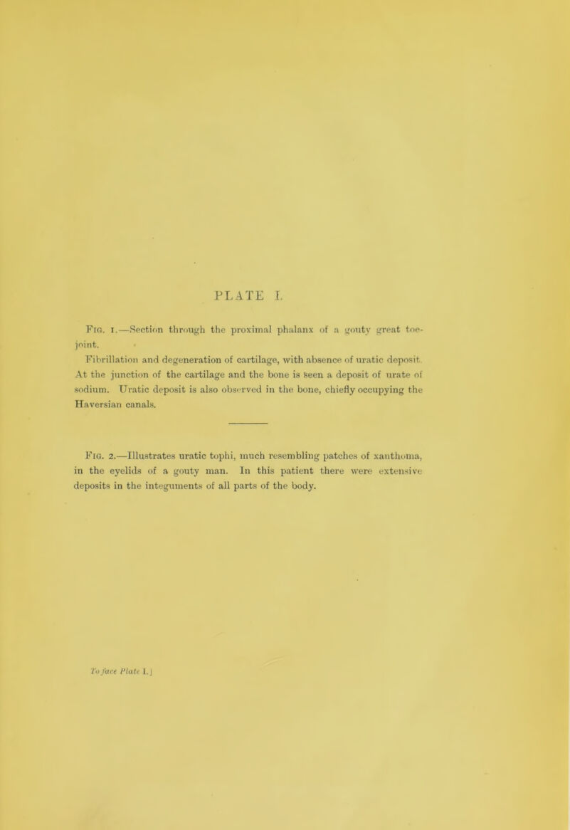 PLATE f. Fir. i.—Section through the proximal phalanx of a gouty great toe- joint. Fibrillation and degeneration of cartilage, with absence of uratic deposit At the junction of the cartilage and the bone is Seen a deposit of urate of sodium. Uratic deposit is also observed in the bone, chiefly occupying the Haversian canals. Fig. 2.—Illustrates uratic tophi, much resembling patches of xanthoma, in the eyelids of a gouty man. In this patient there were extensive deposits in the integuments of all parts of the body. To face Plate I. J