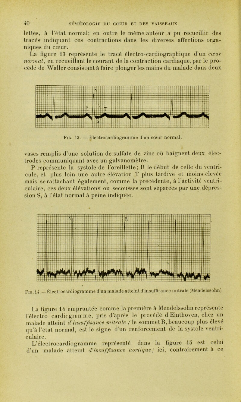 lettes, à l’étal normal; en outre le même auteur a pu recueillir des tracés indiquant ces contractions dans les diverses affections orga- niques du cœur. La figure 13 représente le tracé électro-cardiographique d’un cœur normal, en recueillant le courant de la contraction cardiaque, par le pro- cédé de Waller consistant à faire plonger les mains du malade dans deux Fig. 13. — Électrocardiogramme d’un cœur normal. vases remplis d’une solution de sulfate de zinc où baignent deux élec- trodes communiquant avec un galvanomètre. P représente la systole de l’oreillette; R le début de celle du ventri- cule, et plus loin une autre élévation T plus tardive et moins élevée mais se rattachant également, comme la précédente, à l'activité ventri- culaire, ces deux élévations ou secousses sont séparées par une dépres- sions, à l’état normal à peine indiquée. pIGi — Éleclrocardiogramme d'un malade atteint d’insuffisance mitrale (Mendelssohn) La figure 14 empruntée comme la première à Mendelssohn représente l’électro cardiogramme, pris d'après le procédé d Einlhoven, chez un malade atteint d'insuffisance mitrale ; le sommet R, beaucoup plus élevé qu’à l’état normal, est le signe d’un renforcement de la systole ventri- culaire. L’électrocardiogramme représenté dans la figure 13 est celui d’un malade atteint d'insuffisance aortique ; ici, contrairement à ce
