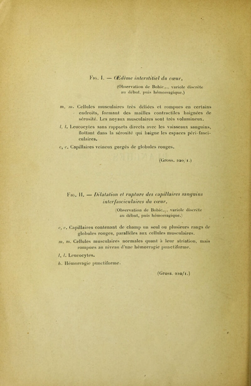 l'iG. I. — OEdème interstitiel du cœur. (Observation de Bobic.... variole diserèle au débul. puis hémori-agique,) rn. m. Cellules musculaires très déliées et rompues en certains endroits, formant des mailles contractiles baignées de sérosité. Les noyaux musculaires sont très volumineux. /, /. Leucocytes sans rapports directs avec les vaisseaux sanguins, flottant dans la sérosité (pii baigne les espaces péri-fasci- culaires. c, c. Capillaires veineux gorgés de globules rouges, (Cross. 220/1.) Fig, II. — Dilutation et rupture des capillaires sanç/uius interfasciculaires du c<eur. (Observation de Bobic..., variole discrète au début, puis hémorragitpie.) c, r. Capillaires contenant de cliam)) un seul ou plusieurs rangs de glolmles rouges, parallèles aux cellules musculaires. /)!. m. Cellules musculaires normales quant à leur striation, mais rompues au niveau d’uni' hémorragie punctiforme. I, t. Leucocytes. h. Hémorragie ptinctifoi'ino.