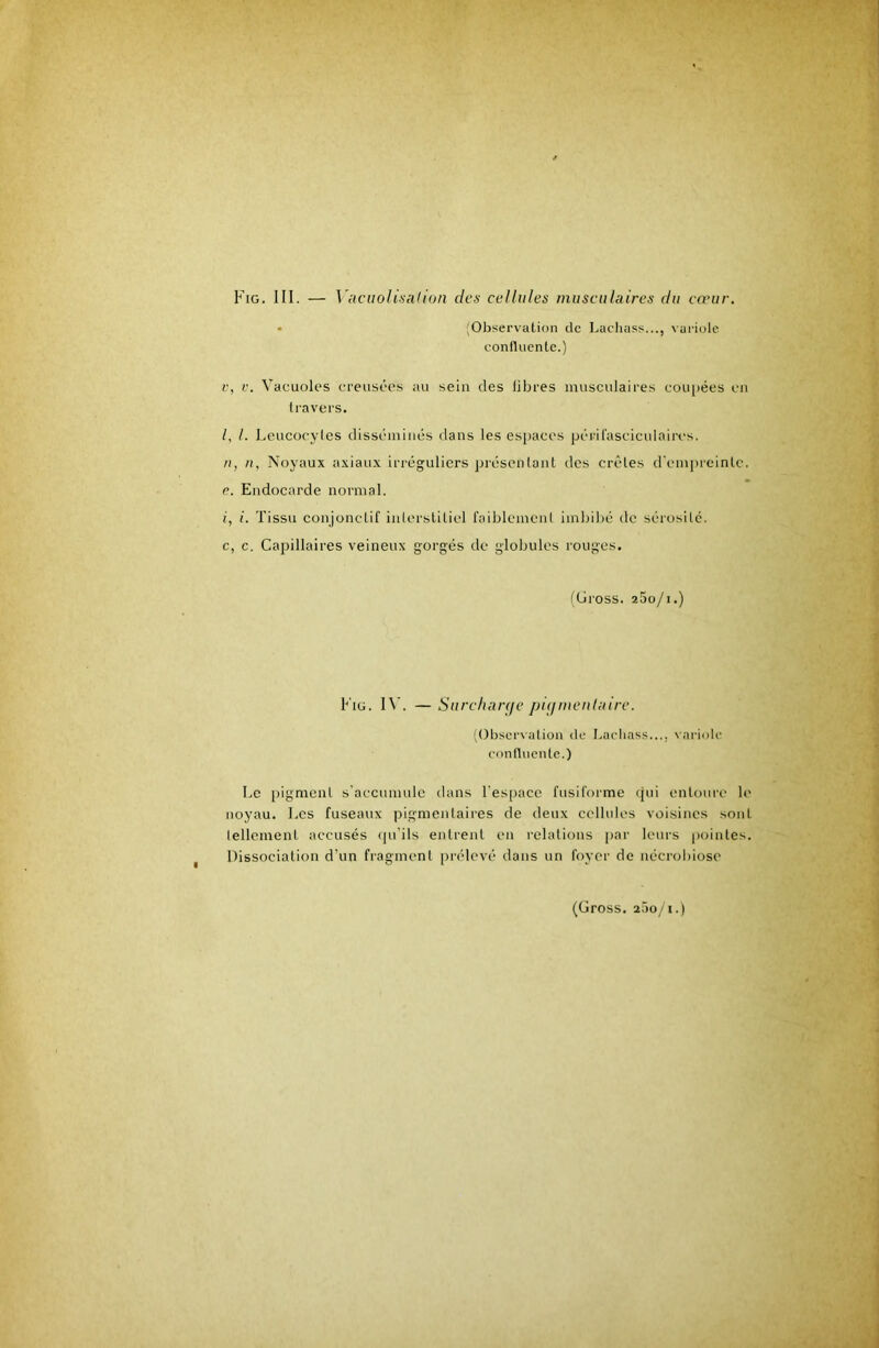 PiG. III. — VacuoU)>alion des cellules musculaires du cœur. • ^Observation de Lacliass..., vai'iole confluente.) V, L\ Vacuoles creusées au sein des libres musculaires cou[)ées en travers. /, /. Leucocyles disséminés dans les espaces péril'asciculaires. Il, n, Noyaux axiaux irréguliers présentant des crêtes d'empreinte, e. Endocarde normal. i, i. Tissu conjonctif inlerstiticl faiblcmenl imbi))é de sérosité, c, c. Capillaires veineux gorgés de globules rouges. (Cross. 25o/i.) Fig. IV. — Surchanje piijmentaire. l()bser\alion de Lacliass..., variole confluente.) Le pigment s'accumule dans l'espace fusiforme (jui entoure le noyau. Les fuseaux pigmentaires de deux cellules voisines sont lellcment accusés (pi’ils entrent en relations par leurs pointes. Dissociation d’un fragment prélevé dans un foyer de nécrobiose