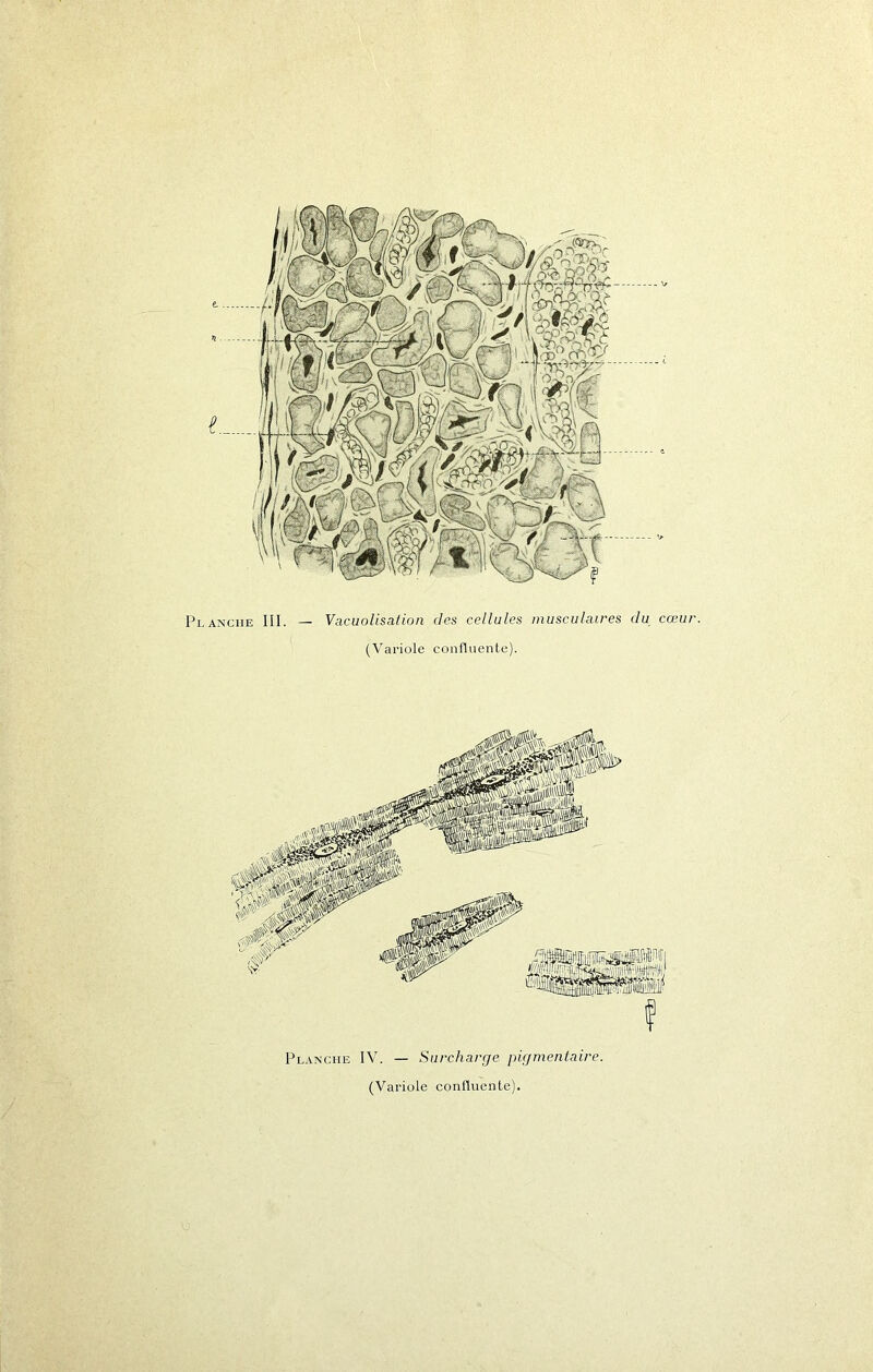 PLANCHE III. — Vacuolisation des cellules musculaires du cœur. (Variole confluente). Planche IV. — Surcharge pigmentaire. (Variole confluente).