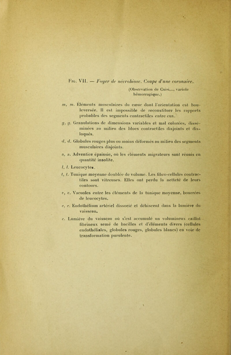 Fig. vu. — Fnifer de nécrahiosc. Coupe d'une coronaire. (Ol)servalion île Cuisi..., variule hémorragique.) //I, rn. Elénu'iils musculaires ilu cœur dont rorientalioii est bou- leversée. 11 est impossible de l•econsliluel■ les raiiporls probables des segments conlraclilcs entre eux. ,7, (J. üranulalions de dimensions variables et mal colorées, dissé- minées au milieu des lilocs contractiles disjoints cl dis- loqués. d, d. Globules rouges plus ou moins déformés au milieu des segments musculaires disjoints. a, a. Adventice épaissie, où les éléments migrateurs sont réunis en ([uantité insolite. /, L Lcucocytet. G (. Tunique moyenne doublée de volume. Les libro-cellules contrac- tiles sont vitreuses. Elles ont perdu la netteté de leurs contours. V, V. Vacuoles entre les éléments de la tunique moyenne, bourrées de leucocytes. e, e. Endothélium artériel dissocié et déhiscenl dans la lumière du vaisseau. c. Lumière du vaisseau où s’esl accumulé un volumineux caillot fibrineux semé de bacilles et d’éléments divers (cellules endothéliales, globules rouges, globules blancs) en voie de transformation purulente.