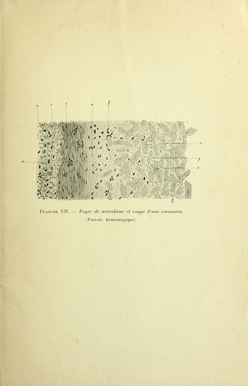 Planche VII. — Foyer de nécrobiose el coupe (Variole liémorragique). d'une coronaire.