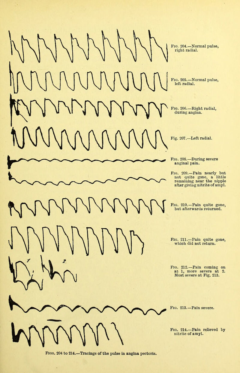 Fio. 204.—Normal pulse, right radial. Pig. 205.—Normal pulse, left radial. Fig. 206—Right radial, during angina. Fig. 207.—Left radial. Fig. 208.—During severe anginal pain. Fig. 209.—Pain nearly but not quite gone, a little remaining near the nipple after giving nitrite of amyl. Fig. 210.—Pain quite gone, but afterwards returned. Pig. 211.—Pain quite gone, which did not return. Fig. 212.—Pain coming on at 1, more severe at 2. Most severe at Fig. 213. Pig. 213.—Pain severe. Pigs. 204 to 214.—Tracings of the pulse in angina pectoris. Fig. 214.—Pain relieved by nitrite of amyl.