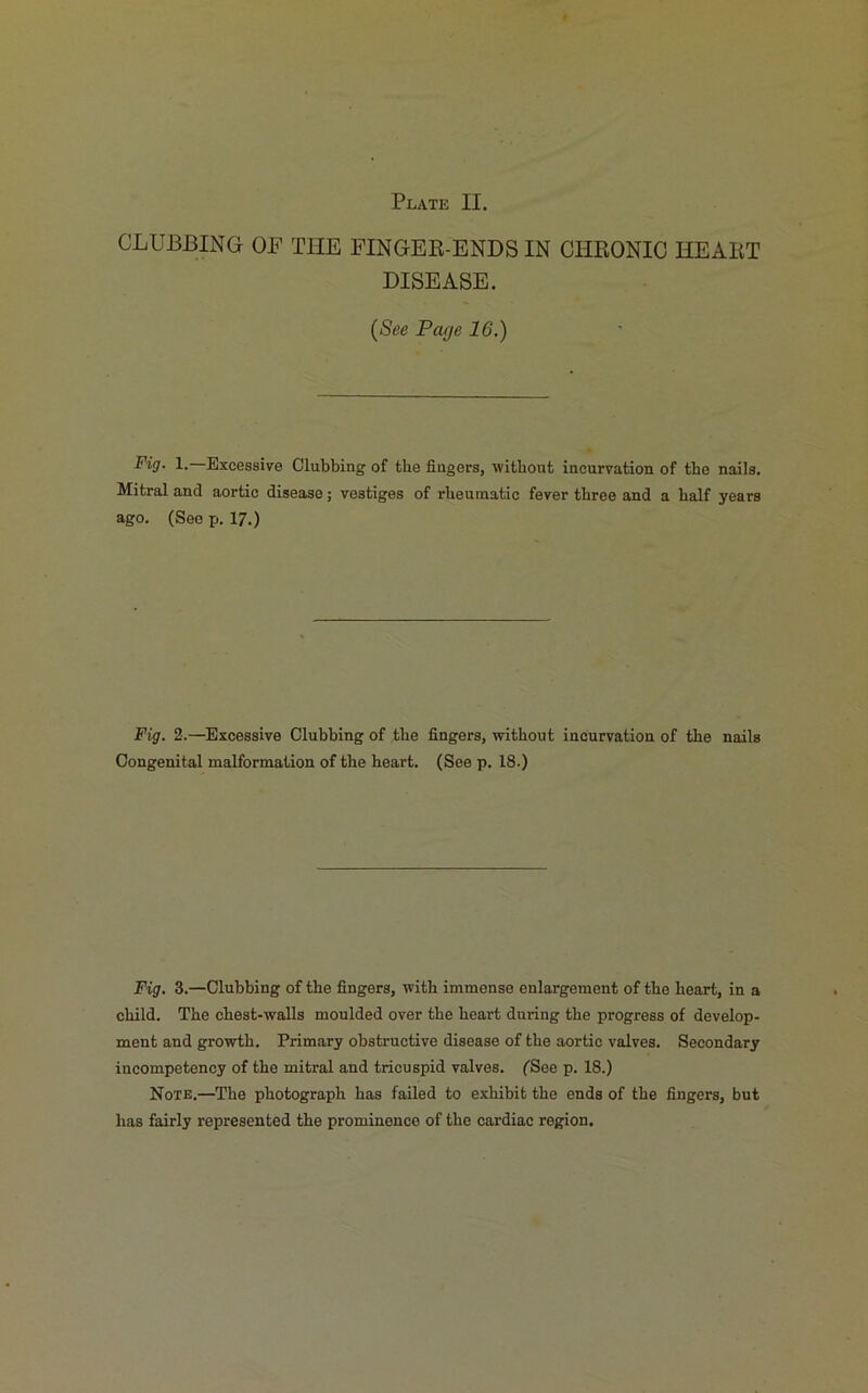 CLUBBING OF THE FINGER-ENDS IN CHRONIC HEART DISEASE. (See Page 16.) Fig. 1.—Excessive Clubbing of the fingers, without incurvation of the nails. Mitral and aortic disease; vestiges of rheumatic fever three and a half years ago. (See p. 17.) Fig. 2.—Excessive Clubbing of the fingers, without incurvation of the nails Congenital malformation of the heart. (See p. 18.) Fig. 3.—Clubbing of the fingers, with immense enlargement of the heart, in a child. The chest-walls moulded over the heart during the progress of develop- ment and growth. Primary obstructive disease of the aortic valves. Secondary incompetency of the mitral and tricuspid valves. (See p. 18.) Note.—The photograph has failed to exhibit the ends of the fingers, but has fairly represented the prominence of the cardiac region.