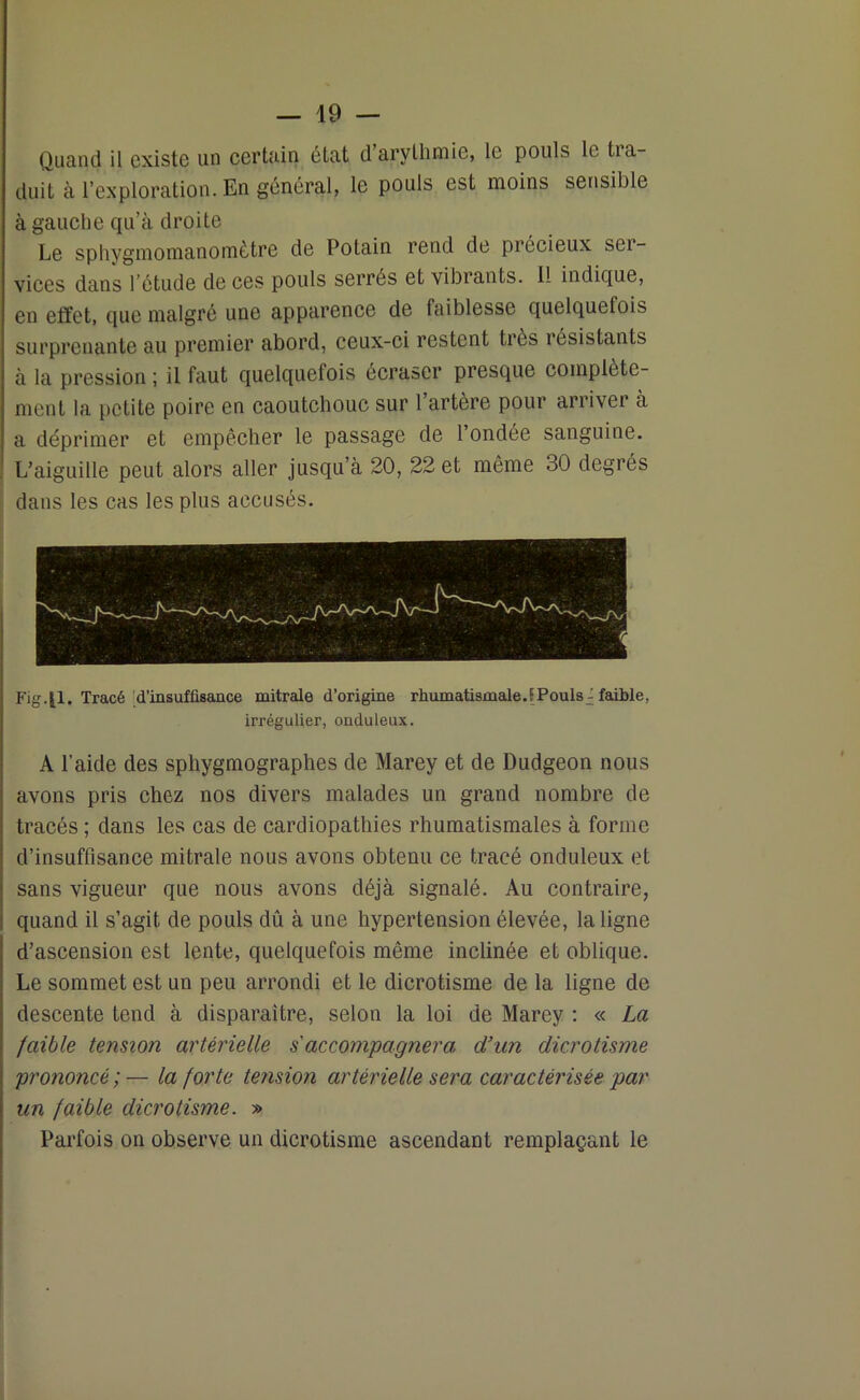 Quand il existe un certain état d arythmie, le pouls le tia- duit à l’exploration. En général, le pouls est moins sensible à gauche qu’à droite Le sphygmomanomètre de Potain rend de précieux sei- vices dans l’étude de ces pouls serrés et vibrants. 11 indique, en effet, que malgré une apparence de faiblesse quelquefois surprenante au premier abord, ceux-ci restent très résistants a la pression ; il faut quelquefois écraser presque complète- ment la petite poire en caoutchouc sur 1 artère pour arriver à a déprimer et empêcher le passage de 1 ondée sanguine. L’aiguille peut alors aller jusqu’à 20, 22 et même 30 degrés dans les cas les plus accusés. Fig,|1. Tracé d'insuffisance mitrale d’origine rhumatismale.'Pouls - faible, irrégulier, onduleux. À l’aide des sphygmographes de Marey et de Dudgeon nous avons pris chez nos divers malades un grand nombre de tracés ; dans les cas de cardiopathies rhumatismales à forme d’insuffisance mitrale nous avons obtenu ce tracé onduleux et sans vigueur que nous avons déjà signalé. Au contraire, quand il s’agit de pouls dû à une hypertension élevée, la ligne d’ascension est lente, quelquefois même inclinée et oblique. Le sommet est un peu arrondi et le dicrotisme de la ligne de descente tend à disparaître, selon la loi de Marey : « La faible tension artérielle s accompagnera, d’un dicrotisme prononcé;— la forte tension artérielle sera caractérisée par un faible dicrotisme. » Parfois on observe un dicrotisme ascendant remplaçant le