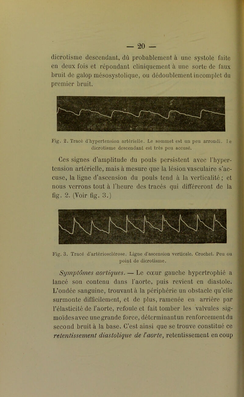 dicrotisme descendant, dû probablement à une systole faite en deux fois et répondant cliniquement à une sorte de faux bruit de galop mésosystolique, ou dédoublement incomplet du premier bruit. Fig. 2. Tracé d'hypertension artérielle. Le sommet est un peu arrondi. l e dicrotisme descendant est très peu accusé. Ces signes d’amplitude du pouls persistent avec l’hyper- tension artérielle, mais à mesure que la lésion vasculaire s’ac- cuse, la ligne d’ascension du pouls tend à la verticalité ; et nous verrons tout à l’heure des tracés qui différeront de la fig. 2. (Voir fig. 3.) Fig. 3. Tracé d’artériosclérose. Ligne d’ascension verticale. Crochet. Peu ou point de dicrotisme. Symptômes aortiques. — Le cœur gauche hypertrophié a lancé son contenu dans l’aorte, puis revient en diastole. L’ondée sanguine, trouvant à la périphérie un obstacle qu’elle surmonte difficilement, et de plus, ramenée en arrière par l’élasticité de l’aorte, refoule et fait tomber les valvules sig- moïdes avec une grande force, déterminantun renforcement du second bruit à la base. C’est ainsi que se trouve constitué ce retentissement diastolique de l'aorte, retentissement en coup