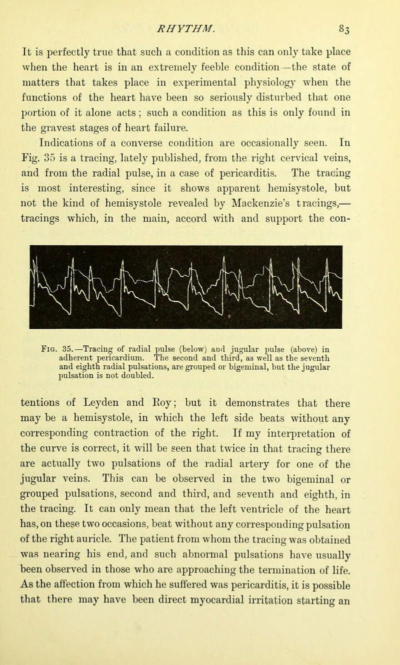 It is perfectly true that such a condition as this can only take place when the heart is in an extremely feeble condition—the state of matters that takes place in experimental physiology when the functions of the heart have been so seriously disturbed that one portion of it alone acts; such a condition as this is only found in the gravest stages of heart failure. Indications of a converse condition are occasionally seen. In Fig. 35 is a tracing, lately published, from the right cervical veins, and from the radial pulse, in a case of pericarditis. The tracing is most interesting, since it shows apparent hemisystole, but not the kind of hemisystole revealed by Mackenzie’s tracings,— tracings which, in the main, accord with and support the con- Fig. 35.—Tracing of radial pulse (below) and jugular pulse (above) in adherent pericardium. The second and third, as well as the seventh and eighth radial pulsations, are grouped or bigeminal, but the jugular pulsation is not doubled. tentions of Leyden and Eoy; but it demonstrates that there may be a hemisystole, in which the left side beats without any corresponding contraction of the right. If my interpretation of the curve is correct, it will be seen that twice in that tracing there are actually two pulsations of the radial artery for one of the jugular veins. This can be observed in the two bigeminal or grouped pulsations, second and third, and seventh and eighth, in the tracing. It can only mean that the left ventricle of the heart has, on these two occasions, beat without any corresponding pulsation of the right auricle. The patient from whom the tracing was obtained was nearing his end, and such abnormal pulsations have usually been observed in those who are approaching the termination of life. As the affection from which he suffered was pericarditis, it is possible that there may have been direct myocardial irritation starting an