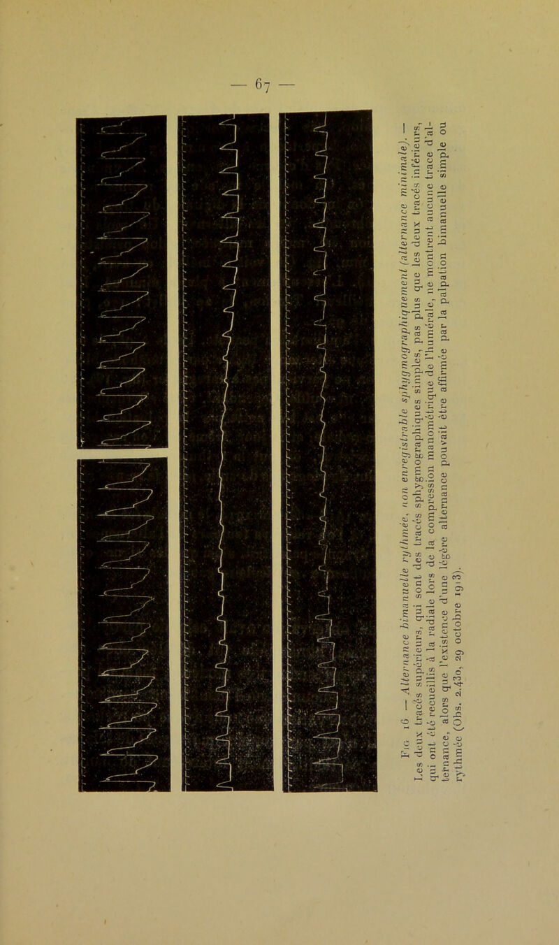 qui onl etc recueillis à la radiale lors de la compression manométrique de l’humérale, ne montrent aucune trace d’al- ternance, alors que l’existence d’une légère alternance pouvait être affirmée par la palpation bimanuelle simple ou rythmée (Obs. 2.430, 29 octobre 1913).