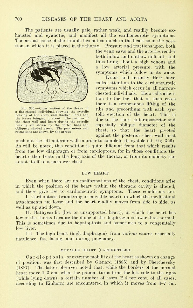 The patients are usually pale, rather weak, and readily become ex- hausted and cyanotic, and manifest all the cardioneurotic symptoms. The actual cause of the trouble lies not so much in the heart as in the posi- tion in which it is placed in the thorax. Pressure and tractions upon both the vense cavse and the arteries render both inflow and outflow difficult, and thus bring about a high venous and a low arterial pressure, with the symptoms which follow in its wake. Kraus and recently Herz have called attention to the cardioneurotic symptoms which occur in all narrow- chested individuals. Herz calls atten- tion to the fact that in such cases there is a tremendous lifting of the ribs and precordium with each sys- tolic erection of the heart. This is due to the short anteroposterior and especially oblique diameter of the chest, so that the heart pivoted against the posterior chest wall must push out the left anterior wall in order to complete its systole (cf. Fig. 326). As will be noted, this condition is quite different from that which results from the low diaphragm or from cardioptosis, for in those conditions the heart either beats in the long axis of the thorax, or from its mobility can adapt itself to a narrower chest. LOW HEART. Even when there are no malformations of the chest, conditions arise in which the position of the heart within the thoracic cavity is altered, and these give rise to cardioneurotic symptoms. These conditions are: I. Cardioptosis (wandering or movable heart), in which the mediastinal attachments are loose and the heart readily moves from side to side, as well as up and down. II. Bathycardia (low or unsupported heart), in which the heart lies low in the thorax because the dome of the diaphragm is lower than normal. This is sometimes due to hepatoptosis and sometimes to a congenitally low liver. III. The high heart (high diaphragm), from various causes, especially flatulence, fat, lacing, and during pregnancy. MOVABLE HEART (CARDIOPTOSIS). Cardioptosis, or extreme mobility of the heart as shown on change of position, was first described by Glenard (1885) and by Cherchevsky (1887). The latter observer noted that, while the borders of the normal heart move 1-3 cm. when the patient turns from the left side to the right (while lying down), a certain number of cases (2.4 per cent, of all cases, according to Einhorn) are encountered in which it moves from 4-7 cm. Fig. 326.— Cross section of the thorax of a flat-chested individual, showing the systolic heaving of the chest wall (broken lines) and the forces bringing it about. The outlines of the chest wall and heart during the systolic heaving are shown by the dotted lines and obliquely shaded areas. The protrusions and retractions are shown by the arrows.