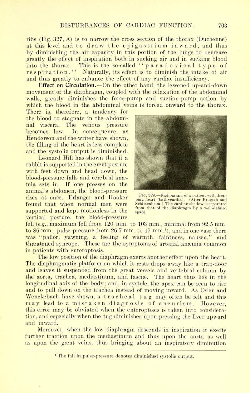 ribs (Fig. 327, A) is to narrow the cross section of the thorax (Duchenne) at this level and to draw the epigastrium inward, and thus by diminishing the air capacity in this portion of the lungs to decrease greatly the effect of inspiration both in sucking air and in sucking blood into the thorax. This is the so-called ‘‘paradoxical type of respiration.’’ Naturally, its effect is to diminish the intake of air and thus greatly to enhance the effect of any cardiac insufficiency. Effect on Circulation.—On the other hand, the lessened up-and-down movement of the diaphragm, coupled with the relaxation of the abdominal walls, greatly diminishes the force-pump and suction-pump action by which the blood in the abdominal veins is forced onward to the thorax. There is, therefore, a tendency for the blood to stagnate in the abdomi- nal viscera. The venous pressure becomes low. In consequence, as Henderson and the writer have shown, the filling of the heart is less complete and the systolic output is diminished. Leonard Hill has shown that if a rabbit is supported in the erect posture with feet down and head down, the blood-pressure falls and cerebral ana>- mia sets in. If one presses on the animal’s abdomen, the blood-pressure rises at once. Erlanger and Hooker found that when normal men were supported and kept motionless in the vertical posture, the blood-pressure fell {e.g., maximum fell from 120 mm. to 103 mm., minimal from 92.5 mm. to 86 mm., pulse-pressure from 26.7 mm. to 17 mm.‘), and in one case there was “pallor, yawning, a feeling of warmth, faintness, nausea,” and threatened syncope. These are the symptoms of arterial anaemia common in patients with enteroptosis. The low position of the diaphragm exerts another effect upon the heart. The diaphragmatic platform on which it rests drops away like a trap-door and leaves it suspended from the great vessels and vertebral column by the aorta, trachea, mediastinum, and fasciae. The heart thus lies in the longitudinal axis of the body; and, in systole, the apex can be seen to rise and to pull down on the trachea instead of moving inward. As Osier and Wenckebach have shown, a tracheal tug may often be felt and this may lead to a mistaken diagnosis of aneurism. However, this error may be obviated when the enteroptosis is taken into considera- tion, and especially when the tug diminishes upon pressing the liver upward and inward. Moreover, when the low diaphragm descends in inspiration it exerts further traction upon the mediastinum and thus upon the aorta as well as upon the great veins, thus bringing about an inspiratory diminution * The fall in pulse-pressure denotes diminished systolic output. Fig. 328.—Radiograph of a patient with drop- ping heart (bathycardia). (.After Brugsch and Scliittenhelm.) Tlie cardiac sliadow is separated from that of the diaphragm by a well-defined space.