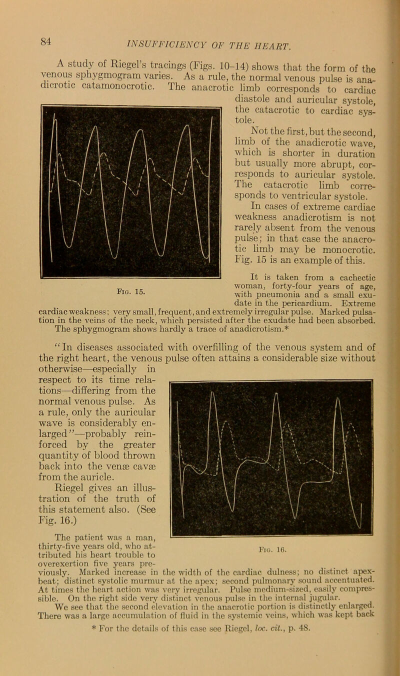 A study of Riegers tracings (Figs. 10-14) shows that the form of the venous sphygmogram varies. As a rule, the normal venous pulse is ana- diciotic catamonocrotic. The anacrotic limb corresponds to cardiac diastole and auricular systole, the catacrotic to cardiac sys- tole. Not the first, but the second, limb of the anadicrotic wave, which is shorter in duration but usually more abrupt, cor- responds to auricular systole. The catacrotic limb corre- sponds to ventricular systole. In cases of extreme cardiac weakness anadicrotism is not rarely absent from the venous pulse; in that case the anacro- tic limb may be monocrotic. Fig. 15 is an example of this. It is taken from a cachectic woman, forty-four years of age, with pneumonia and a small exu- date in the pericardium. Extreme cardiac weakness; very small, frequent, and extremely irregular pulse. Marked pulsa- tion in the veins of the neck, which persisted after the exudate had been absorbed. The sphygmogram shows hardly a trace of anadicrotism.* “In diseases associated with overfilling of the venous system and of the right heart, the venous pulse often attains a considerable size without otherwise—especially in respect to its time rela- tions—differing from the normal venous pulse. As a rule, only the auricular wave is considerably en- larged”—probably rein- forced by the greater quantity of blood thrown back into the venae cavae from the auricle. Riegel gives an illus- tration of the truth of this statement also. (See Fig. 16.) The patient wras a man, thirty-five years old, who at- tributed his heart trouble to overexertion five years pre- viously. Marked increase in the width of the cardiac dulness; no distinct apex- beat; distinct systolic murmur at the apex; second pulmonary sound accentuated. At times the heart action vras very irregular. Pulse medium-sized, easily compres- sible. On the right side very distinct venous pulse in the internal jugular. We see that the second elevation in the anacrotic portion is distinctly enlarged. There was a large accumulation of fluid in the systemic veins, which was kept back * For the details of this case see Riegel, loc. cit., p. 48.