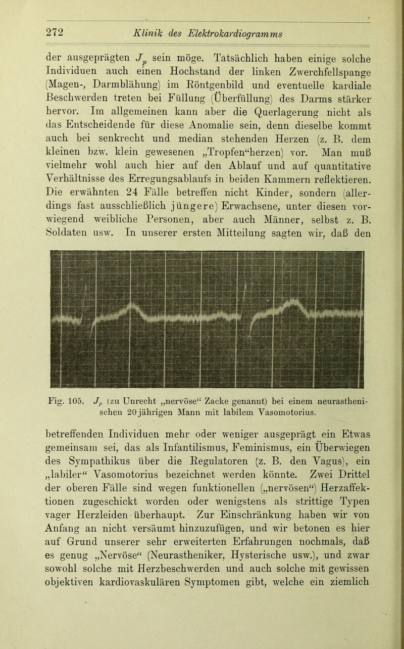 der ausgeprägten sein möge. Tatsächlich haben einige solche Individuen auch einen Hochstand der linken Zwerchfellspange (Magen-, Darmblähung) im Eöntgenbild und eventuelle kardiale Beschwerden treten bei Füllung (Überfüllung) des Darms stärker hervor. Im allgemeinen kann aber die Querlagerung nicht als das Entscheidende für diese Anomalie sein, denn dieselbe kommt auch bei senkrecht und median stehenden Herzen (z. B. dem kleinen hzw. klein gewesenen ,,Tropfen“herzen) vor. Man muß vielmehr wohl auch hier auf den Ablauf und auf quantitative Verhältnisse des Erregungsablaufs in beiden Kammern reflektieren. Die erwähnten 24 Fälle betreffen nicht Kinder, sondern (aller- dings fast ausschließlich jüngere) Erwachsene, unter diesen vor- wiegend weibliche Personen, aber auch Männer, selbst z. B. Soldaten usw. In unserer ersten Mitteilung sagten wir, daß den Fig. 105. Jp (zu Unrecht ,,nervöse“ Zacke genannt) bei einem neurastheni- schen 20 jährigen Mann mit labilem Vasomotorius. betreffenden Individuen mehr oder weniger ausgeprägt ein Etwas gemeinsam sei, das als Infantilismus, Feminismus, ein Überwiegen des Sympathikus über die Eegulatoren (z. B. den Vagus), ein „labiler“ Vasomotorius bezeichnet werden könnte. Zwei Drittel der oberen Fälle sind wegen funktionellen („nervösen“) Herzaffek- tionen zugeschickt worden oder wenigstens als strittige Typen vager Herzleiden überhaupt. Zur Einschränkung haben wir von Anfang an nicht versäumt hinzuzufügen, und wir betonen es hier auf Grund unserer sehr erweiterten Erfahrungen nochmals, daß es genug „Nervöse“ (Neurastheniker, Hysterische usw.), und zwar sowohl solche mit Herzbeschwerden und auch solche mit gewissen objektiven kardiovaskulären Symptomen gibt, welche ein ziemlich