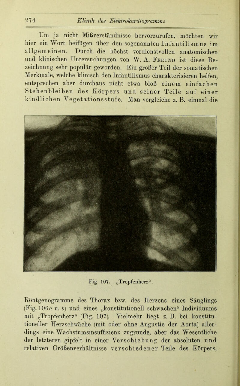 Um ja nicht Mißverständnisse hervorzurufen, möchten wir hier ein Wort heifügen über den sogenannten Infantilismus im allgemeinen. Durch die höchst verdienstvollen anatomischen und klinischen Untersuchungen von W. A. Freund ist diese Be- zeichnung sehr populär geworden. Ein großer Teil der somatischen Merkmale, welche klinisch den Infantilismus charakterisieren helfen, entsprechen aber durchaus nicht etwa bloß einem einfachen Stehenbleiben des Körpers und seiner Teile auf einer kindlichen Vegetationsstufe. Man vergleiche z. ß. einmal die Fig. 107. „Tropfenherz“. Eöntgenogramme des Thorax bzw. des Herzens eines Säuglings (Fig. 106« u. b) und eines „konstitutionell schwachen“ Individuums mit „Tropfenherz“ (Fig. 107). Vielmehr liegt z. B. hei konstitu- tioneller Herzschwäche (mit oder ohne Angustie der Aorta) aller- dings eine Wachstumsinsuffizienz zugrunde, aber das Wesentliche der letzteren gipfelt in einer Verschiebung der absoluten und relativen Größenverhältnisse verschiedener Teile des Körpers,