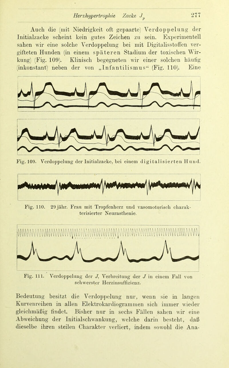 Auch die (mit Niedrigkeit oft gepaarte) Verdoppelung der Initialzacke scheint kein gutes Zeichen zu sein. Experimentell sahen -wir eine solche Verdoppelung hei mit Digitalisstoffen ver- gifteten Hunden (in einem späteren Stadium der toxischen Wir- kung) (Fig. 109). Klinisch hegegneten wir einer solchen häufig (inkonstant) neben der von „Infantilismus“ (Fig. 110). Eine Fig. 109. Verdoppelung der Initialzacke, bei einem digitalisierten Hund. Fig. 110. 29jälir. Frau mit Tropfenherz und vasomotorisch charak terisierter Neurasthenie. Fig. 111. Verdoppelung der J, Verbreitung der J in einem Fall von schwerster Herzinsuffizienz. Bedeutung besitzt die Verdoppelung nur, wenn sie in langen Kurvenreihen in allen Elektrokardiogrammen sich immer wieder gleichmäßig findet. Bisher nur in sechs Fällen sahen wir eine Abweichung der Initialschwankung, welche darin besteht, daß dieselbe ihren steilen Charakter verliert, indem sowohl die Ana-