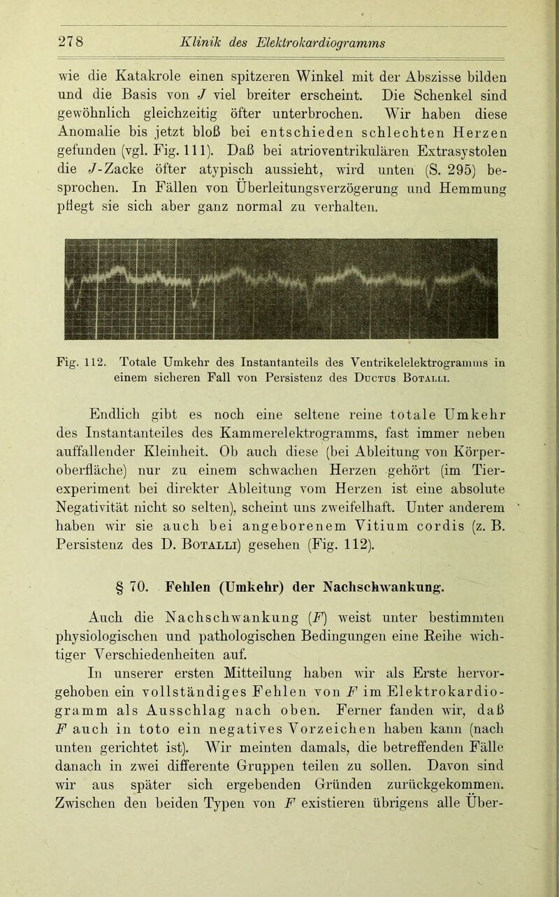 wie die Katakrole einen spitzeren Winkel mit der Abszisse bilden und die Basis von J viel breiter erscheint. Die Schenkel sind gewöhnlich gleichzeitig öfter unterbrochen. Wir haben diese Anomalie bis jetzt bloß bei entschieden schlechten Herzen gefunden (vgl. Fig. 111). Daß bei atrioventrikulären Extrasystolen die /-Zacke öfter atypisch aussieht, wird unten (S. 295) be- sprochen. In Fällen von Überleitungsverzögerung und Hemmung pHegt sie sich aber ganz normal zu verhalten. Fig. 112. Totale Umkehr des Instantanteils des Veutrikelelektrogramms in einem sicheren Fall von Persistenz des Ductus Botälli. Endlich gibt es noch eine seltene reine totale Umkehr des Instantanteiles des Kammerelektrogramms, fast immer neben auffallender Kleinheit. Ob auch diese (bei Ableitung von Körper- oberfläche) nur zu einem schwachen Herzen gehört (im Tier- experiment bei direkter Ableitung vom Herzen ist eine absolute Negativität nicht so selten), scheint uns zweifelhaft. Unter anderem haben wir sie auch bei angeborenem Vitium cordis (z. B. Persistenz des D. Botalli) gesehen (Fig. 112). § 70. Fehlen (Umkehr) der Nachschwankung. Auch die Nachschwankung [F] wmist unter bestimmten physiologischen und pathologischen Bedingungen eine Reihe wich- tiger Verschiedenheiten auf. In unserer ersten Mitteilung haben wir als Erste hervor- gehoben ein vollständiges Fehlen von F im Elektrokardio- gramm als Ausschlag nach oben. Ferner fanden wir, daß F auch in toto ein negatives Vorzeichen haben kann (nach unten gerichtet ist). Wir meinten damals, die betreffenden Fälle danach in zwei differente Gruppen teilen zu sollen. Davon sind wir aus später sich ergebenden Gründen zurückgekommen. Zwischen den beiden Typen von F existieren übrigens alle Über-