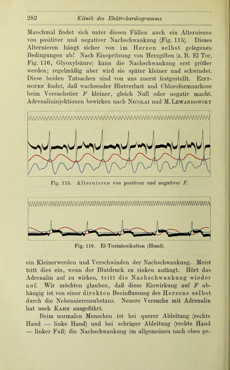 Manchmal findet sich unter diesen Fällen auch ein Alternieren von positiver und negativer Nachschwankung (Fig. 115). Dieses Alternieren hängt sicher von im Herzen seihst gelegenen Bedingungen ah! Nach Einspritzung von Herzgiften (z. B. El Tor, Fig. 116, Glyoxylsäure) kann die Nachschwankung erst größer werden; regelmäßig aber wird sie später kleiner und schwindet. Diese beiden Tatsachen sind von uns zuerst festgestellt. Eint- HOFEN findet, daß wachsender Blutverlust und Chloroformnarkose heim Versuchstier F kleiner, gleich Null oder negativ macht. Adrenalininjektionen bewirken nach Nicolai und M.Lewandüwsky Fig. 115. Alternieren von positiver und negativer F. Fig. 116. El-Toxintoxikation (Hund). ein Kleinerwerden und Verschwinden der Nachschwankung. Meist tritt dies ein, wenn der Blutdruck zu sinken anlängt. Hört das Adrenalin auf zu wirken, tritt die Nachschwankung wieder auf. Wir möchten glauben, daß diese Einwirkung auf F ab- hängig ist von einer direkten Beeinflussung des Herzens selbst durch die Nebennierensuhstanz. Neuere Versuche mit Adrenahn hat noch Kahn ausgeführt. Beim normalen Menschen ist bei querer Ableitung (rechte Hand — linke Hand) und bei schräger Ableitung (rechte Hand — linker Fuß) die Nachschwankung im allgemeinen nach oben ge-