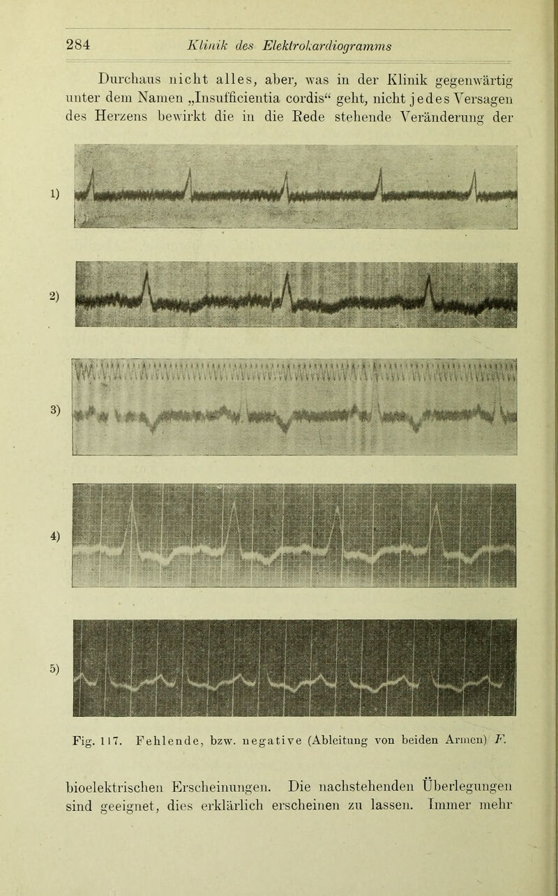 Durchaus nicht alles, aber, was in der Klinik gegenwärtig unter dem Namen „Insufficientia cordis“ geht, nicht j e d e s Versagen des Herzens bewirkt die in die Rede stehende Veränderung der 3) ffVi..';, a... t‘. .’.Vm * vVwM'v'//»'iyViv»Wvv'f.Vi hioelektrischen Erscheinungen. Die nachstehenden Überlegungen sind geeignet, dies erklärlich erscheinen zu lassen. Immer mehr