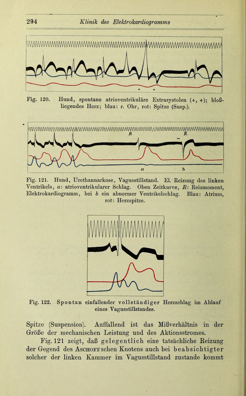 Fig. 120. Hund, spontane atrioventrikuläre Extrasystolen (+, +); bloß- liegendes Herz; blau: r. Obr, rot; Spitze (Susp.). ^ Fig. 121. Hund, Uretbannarkose, Vagusstillstand. El. Eeizung des linken Ventrikels, a: atrioventrikularer Schlag. Oben Zeitkurve, B-. Eeizmoment, Elektrokardiogramm, bei b ein abnormer Ventrikelscblag. Blau; Atrium, rot: Herzspitze. Fig. 122. Spontan einfallender vollständiger Herzschlag im Ablauf eines Vagusstillstandes. Spitze (Suspension). Auffallend ist das Mißverhältnis in der Größe der mechanischen Leistung und des Aktionsstromes. Fig. 121 zeigt, daß gelegentlich eine tatsächliche Eeizung der Gegend des Aschoitsehen Knotens auch hei beabsichtigter solcher der linken Kammer im Vagusstillstand zustande kommt