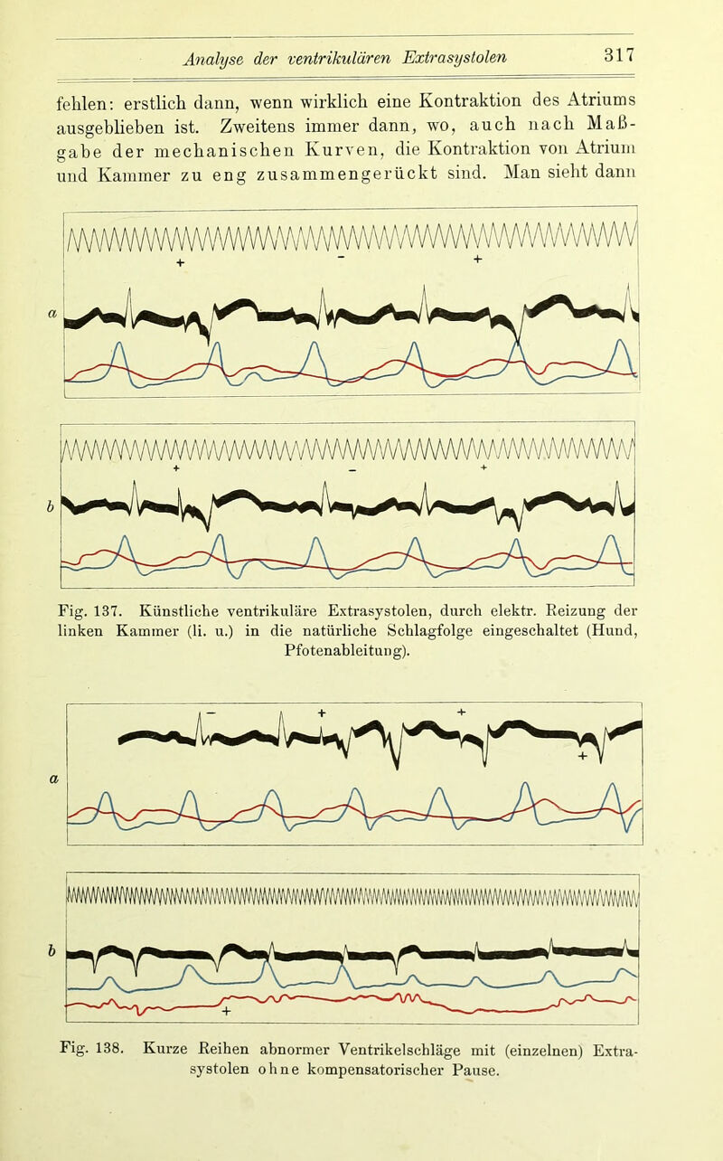 fehlen; erstlich dann, wenn wirklich eine Kontraktion des Atriums ausgehlieben ist. Zweitens immer dann, wo, auch nach Maß- gabe der mechanischen Kurven, die Kontraktion von Atrium und Kammer zu eng zusammengerückt sind. Man sieht dann A/v#./\wvvwwvvvWv'y\/wv + + Fig. 137. Künstliche ventrikuläre Extrasystolen, durch elektr. Reizung der linken Kammer (li. u.) in die natürliche Schlagfolge eingeschaltet (Hund, Pfotenahleitun g). Fig. 138. Kurze Reihen abnormer Ventrikelschläge mit (einzelnen) Extra- systolen ohne kompensatorischer Pause.