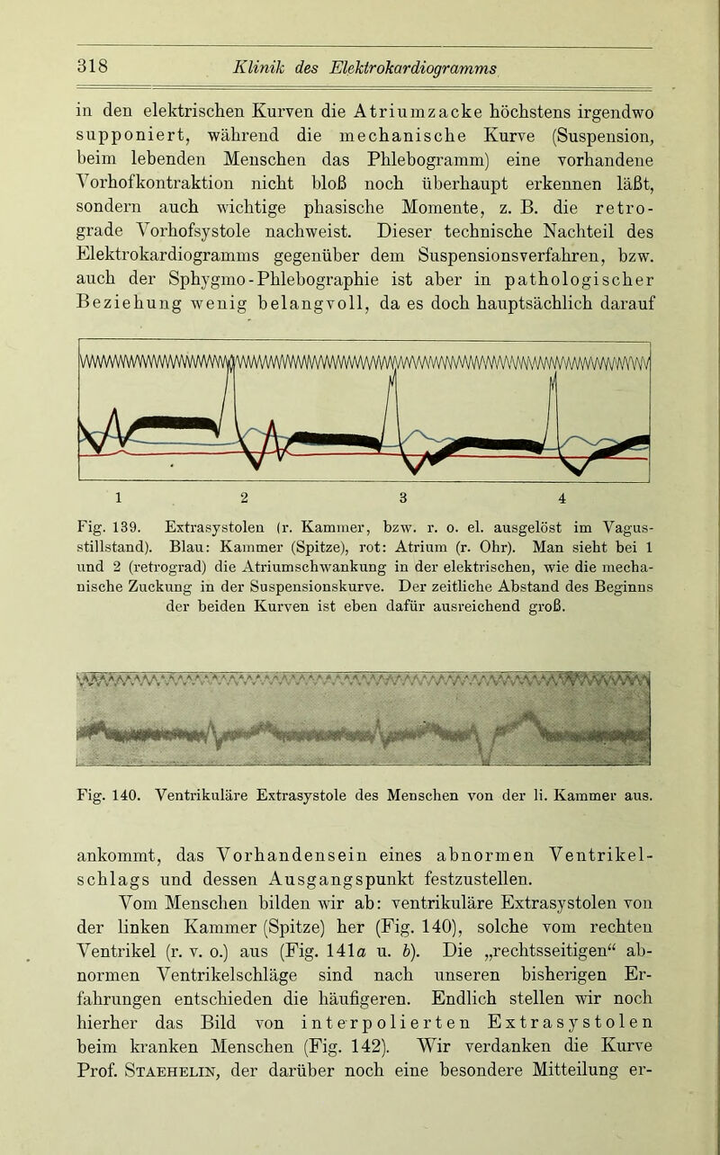 in den elektrischen Kurven die Atrium zacke höchstens irgendwo supponiert, während die mechanische Kurve (Suspension, beim lebenden Menschen das Phlebogramm) eine vorhandene Yorhofkontraktion nicht bloß noch überhaupt erkennen läßt, sondern auch wichtige phasische Momente, z. B. die retro- grade Vorhofsystole nachweist. Dieser technische Nachteil des Elektrokardiogramms gegenüber dem Suspensionsverfahren, bzw. auch der Sphygmo-Phlebographie ist aber in pathologischer Beziehung wenig belangvoll, da es doch hauptsächlich darauf Fig. 139. Extrasystolen (r. Kammer, bzw. r. o. el. ausgelöst im Vagus- stillstand). Blau: Kammer (Spitze), rot: Atrium (r. Ohr). Man sieht bei 1 und 2 (retrograd) die Atriumschwankung in der elektrischen, wie die mecha- nische Zuckung in der Suspensionskurve. Der zeitliche Abstand des Beginns der beiden Kurven ist eben dafür ausreichend groß. Fig. 140. Ventrikuläre Extrasystole des Menschen von der li. Kammer aus. ankommt, das Vorhandensein eines abnormen Ventrikel- schlags und dessen Ausgangspunkt festzustellen. Vom Menschen bilden wir ab: ventrikuläre Extrasystolen von der linken Kammer (Spitze) her (Fig. 140), solche vom rechten Ventrikel (r. v. o.) aus (Fig. 141o u. h). Die „rechtsseitigen“ ab- normen Ventrikelschläge sind nach unseren bisherigen Er- fahrungen entschieden die häufigeren. Endlich stellen wir noch hierher das Bild von interpolierten Extrasystolen beim kranken Menschen (Fig. 142). Wir verdanken die Kurve Prof. Staehelin, der darüber noch eine besondere Mitteilung er-