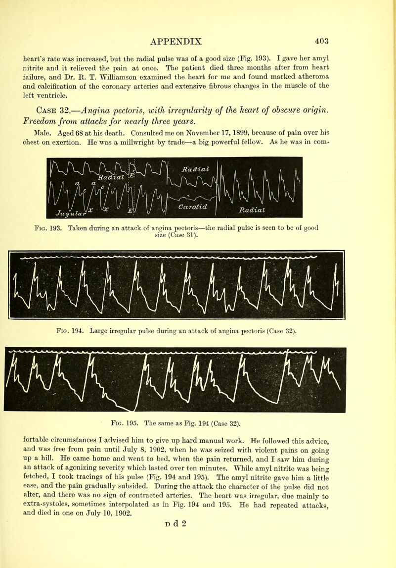 heart’s rate was increased, but the radial pulse was of a good size (Fig. 193). I gave her amyl nitrite and it relieved the pain at once. The patient died three months after from heart failure, and Dr. R. T. Williamson examined the heart for me and found marked atheroma and calcification of the coronary arteries and extensive fibrous changes in the muscle of the left ventricle. Case 32.—Angina pectoris, with irregularity of the heart of obscure origin. Freedom from attacks for nearly three years. Male. Aged 68 at his death. Consulted me on November 17,1899, because of pain over his chest on exertion. He was a millwright by trade—a big powerful fellow. As he was in com- Fig. 193. Taken during an attack of angina pectoris—the radial pulse is seen to be of good size (Case 31). Fig. 194. Large irregular pulse during an attack of angina pectoris (Case 32). Fig. 195. The same as Fig. 194 (Case 32). fortable circumstances I advised him to give up hard manual work. He followed this advice, and was free from pain until July 8, 1902, when he was seized with violent pains on going up a hill. He came home and went to bed, when the pain returned, and I saw him during an attack of agonizing severity which lasted over ten minutes. While amyl nitrite was being fetched, I took tracings of his pulse (Fig. 194 and 195). The amyl nitrite gave him a little ease, and the pain gradually subsided. During the attack the character of the pulse did not alter, and there was no sign of contracted arteries. The heart was irregular, due mainly to extra-systoles, sometimes interpolated as in Fig. 194 and 195. He had repeated attacks, and died in one on July 10, 1902. D d 2