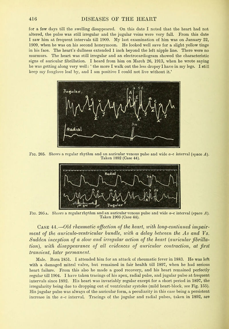 for a few days till the swelling disappeared. On this date I noted that the heart had not altered, the pulse was still irregular and the jugular veins were very full. From this date I saw him at frequent intervals till 1909. My last examination of him was on January 22, 1909, when he was on his second honeymoon. He looked well save for a slight yellow tinge in his face. The heart’s dullness extended 1 inch beyond the left nipple line. There were no murmurs. The heart was still irregular and an electrocardiogram showed the characteristic signs of auricular fibrillation. I heard from him on March 26, 1913, when he wrote saying he was getting along very well: ‘ the more I walk out the less dropsy I have in my legs. I still keep my foxglove leaf by, and I am positive I could not live without it.’ Fig. 205. Shows a regular rhythm and an auricular venous pulse and wide a-c interval (space 4). Taken 1892 (Case 44). Fig. 205 a. Shows a regular rhythm and an auricular venous pulse and wide a-c interval (space A). Taken 1903 (Case 44). Case 44.—Old rheumatic affection of the heart, with long-continued impair- ment of the auriculo-ventricular bundle, with a delay between the As and Fs. Sudden inception of a slow and irregular action of the heart (auricular fibrilla- tion), with disappearance of all evidences of auricular contraction, at first transient, later permanent. Male. Born 1851. I attended him for an attack of rheumatic fever in 1883. He was left with a damaged mitral valve, but remained in fair health till 1897, when he had serious heart failure. From this also he made a good recovery, and his heart remained perfectly regular till 1904. I have taken tracings of his apex, radial pulse, and jugular pulse at frequent intervals since 1892. His heart was invariably regular except for a short period in 1897, the irregularity being due to dropping out of ventricular systoles (mild heart-block, see Fig. 155). His jugular pulse was always of the auricular form, a peculiarity in this case being a persistent increase in the a-c interval. Tracings of the jugular and radial pulses, taken in 1892, are