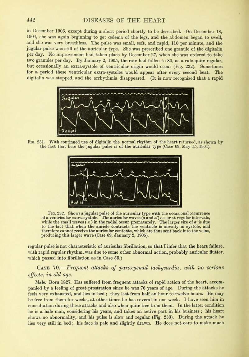 in December 1905, except during a short period shortly to be described. On December 18, 1904, she was again beginning to get oedema of the legs, and the abdomen began to swell, and she was very breathless. The pulse was small, soft, and rapid, 110 per minute, and the jugular pulse was still of the auricular type. She was prescribed one granule of the digitalin per day. No improvement had taken place by December 27, when she was ordered to take two granules per day. By January 2, 1905, the rate had fallen to 80, as a rule quite regular, but occasionally an extra-systole of ventricular origin would occur (Fig. 232). Sometimes for a period these ventricular extra-systoles would appear after every second beat. The digitalin was stopped, and the arrhythmia disappeared. (It is now recognized that a rapid Fig. 231. With continued use of digitalin the normal rhythm of the heart returned, as shown by the fact that here the jugular pulse is of the auricular type (Case 69, May 15, 1904). Fig. 232. Shows a jugular pulse of the auricular type with the occasional occurrence of a ventricular extra-systole. The auricular waves (a and o') occur at regular intervals, while the small waves ( x ) in the radial occur prematurely. The larger size of o' is due to the fact that when the auricle contracts the ventricle is already in systole, and therefore cannot receive the auricular contents, which are thus sent back into the veins, producing this larger wave (Case 69, January 2, 1905). regular pulse is not characteristic of auricular fibrillation, so that I infer that the heart failure, with rapid regular rhythm, was due to some other abnormal action, probably auricular flutter, which passed into fibrillation as in Case 55.) Case 70.—Frequent attacks af paroxysmal tachycardia, with no serious effects, in old age. Male. Bom 1827. Has suffered from frequent attacks of rapid action of the heart, accom- panied by a feeling of great prostration since he was 76 years of age. During the attacks he feels very exhausted, and lies in bed ; they last from half an hour to twelve hours. He may be free from them for weeks, at other times he has several in one week. I have seen him in consultation during these attacks and also when quite free from them. In the latter condition he is a hale man, considering his years, and takes an active part in his business; his heart shows no abnormality, and his pulse is slow and regular (Fig. 233). During the attack he lies very still in bed; his face is pale and slightly drawn. He does not care to make much