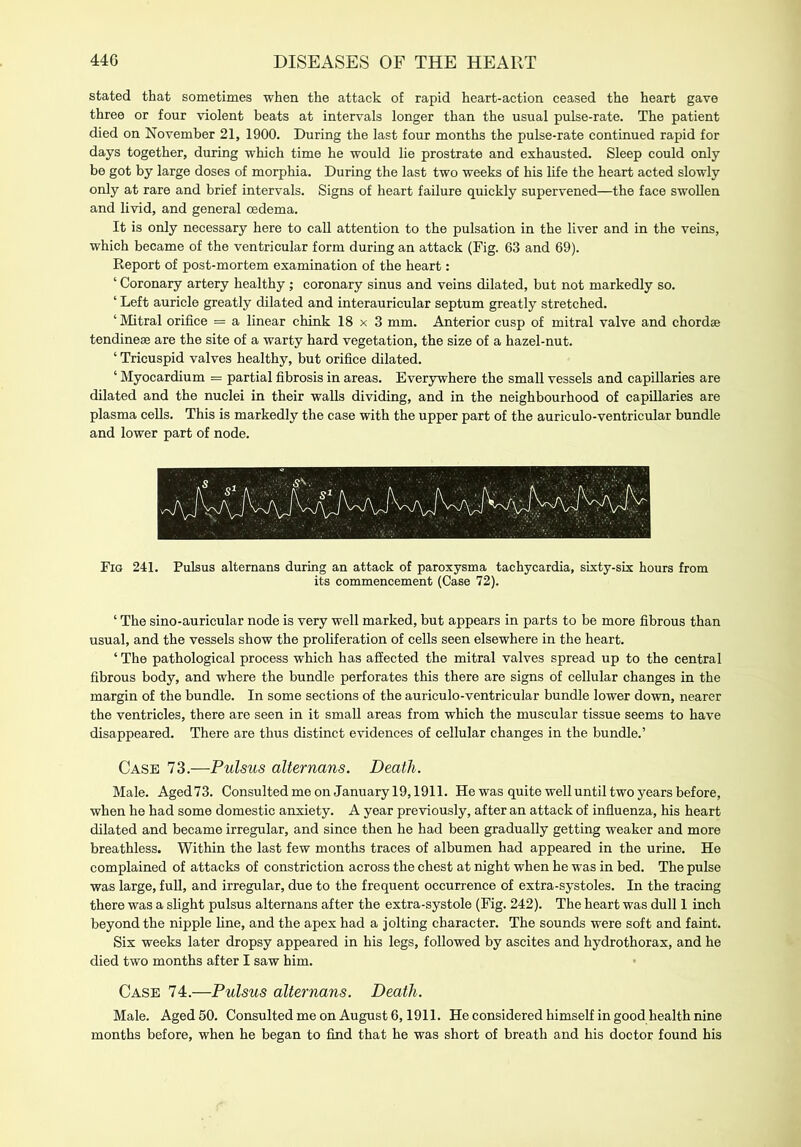 stated that sometimes when the attack of rapid heart-action ceased the heart gave three or four violent beats at intervals longer than the usual pulse-rate. The patient died on November 21, 1900. During the last four months the pulse-rate continued rapid for days together, during which time he would lie prostrate and exhausted. Sleep could only be got by large doses of morphia. During the last two weeks of his life the heart acted slowly only at rare and brief intervals. Signs of heart failure quickly supervened—the face swollen and livid, and general oedema. It is only necessary here to call attention to the pulsation in the liver and in the veins, which became of the ventricular form during an attack (Fig. 63 and 69). Report of post-mortem examination of the heart: ‘ Coronary artery healthy ; coronary sinus and veins dilated, but not markedly so. ‘ Left auricle greatly dilated and interauricular septum greatly stretched. ‘ Mitral orifice = a linear chink 18x3 mm. Anterior cusp of mitral valve and chordae tendineae are the site of a warty hard vegetation, the size of a hazel-nut. ‘ Tricuspid valves healthy, but orifice dilated. ‘ Myocardium = partial fibrosis in areas. Everywhere the small vessels and capillaries are dilated and the nuclei in their walls dividing, and in the neighbourhood of capillaries are plasma cells. This is markedly the case with the upper part of the auriculo-ventricular bundle and lower part of node. Fig 241. Pulsus altemans during an attack of paroxysma tachycardia, sixty-six hours from its commencement (Case 72). ‘ The sino-auricular node is very well marked, but appears in parts to be more fibrous than usual, and the vessels show the proliferation of cells seen elsewhere in the heart. ‘ The pathological process which has affected the mitral valves spread up to the central fibrous body, and where the bundle perforates this there are signs of cellular changes in the margin of the bundle. In some sections of the auriculo-ventricular bundle lower down, nearer the ventricles, there are seen in it small areas from which the muscular tissue seems to have disappeared. There are thus distinct evidences of cellular changes in the bundle.’ Case 73.—Pulsus altemans. Death. Male. Aged73. Consulted me on January 19,1911. He was quite well until two years before, when he had some domestic anxiety. A year previously, after an attack of influenza, his heart dilated and became irregular, and since then he had been gradually getting weaker and more breathless. Within the last few months traces of albumen had appeared in the urine. He complained of attacks of constriction across the chest at night when he was in bed. The pulse was large, full, and irregular, due to the frequent occurrence of extra-systoles. In the tracing there was a slight pulsus altemans after the extra-systole (Fig. 242). The heart was dull 1 inch beyond the nipple line, and the apex had a jolting character. The sounds were soft and faint. Six weeks later dropsy appeared in his legs, followed by ascites and hydrothorax, and he died two months after I saw him. Case 74.—Pulsus altemans. Death. Male. Aged 50. Consulted me on August 6,1911. He considered himself in good health nine months before, when he began to find that he was short of breath and his doctor found his